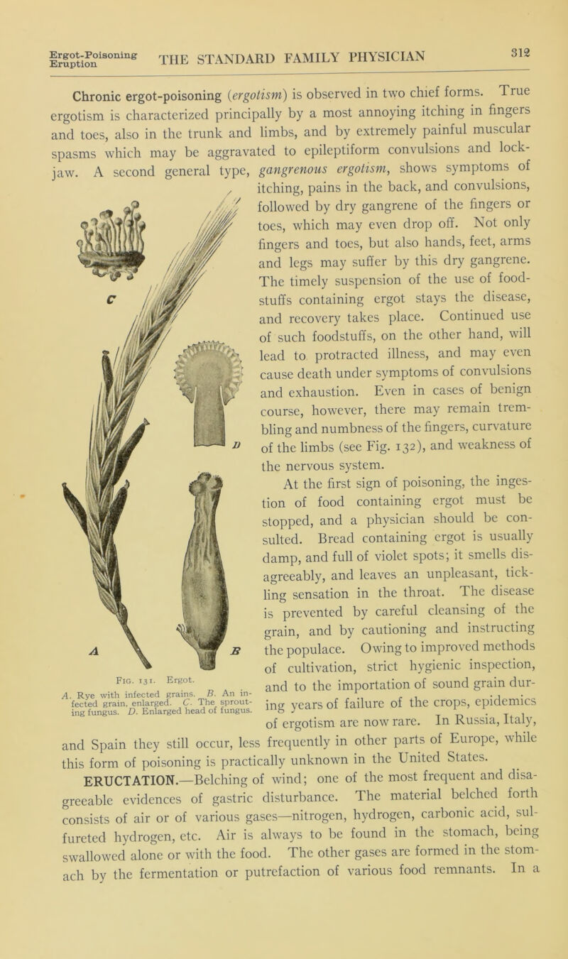 Ergot-Poisoning Eruption THE STANDARD FAMILY PHYSICIAN 312 Chronic ergot-poisoning {ergotism) is observed in two chief forms. True ergotism is characterized principally by a most annoying itching in fingers and toes, also in the trunk and limbs, and by extremely painful muscular spasms which may be aggravated to epileptiform convulsions and lock- jaw. A second general type, gangrenous ergotism, shows symptoms of itching, pains in the back, and convulsions, followed by dry gangrene of the fingers or toes, which may even drop off. Not only fingers and toes, but also hands, feet, arms and legs may suffer by this dry gangrene. The timely suspension of the use of food- stuffs containing ergot stays the disease, and recovery takes place. Continued use of such foodstuffs, on the other hand, will lead to protracted illness, and may even cause death under symptoms of convulsions and exhaustion. Even in cases of benign course, however, there may remain trem- bling and numbness of the fingers, curvature of the limbs (see Fig. 132), and weakness of the nervous system. At the first sign of poisoning, the inges- tion of food containing ergot must be stopped, and a physician should be con- sulted. Bread containing ergot is usually damp, and full of violet spots; it smells dis- agreeably, and leaves an unpleasant, tick- ling sensation in the throat. The disease is prevented by careful cleansing of the grain, and by cautioning and instructing the populace. Owing to improved methods of cultivation, strict hygienic inspection, ^ and to the importation of sound grain dur- A. Rye with infected grains. R. An in- , , - ,i -J • fected grain, enlarged. C. The sprout- ypa j-g of failure of the CrOpS, epiQemiCS ing fungus. D. Enlarged head of fungus. • T 1 of ergotism are now rare. In Russia, Italy, and Spain they still occur, less frequently in other parts of Europe, while this form of poisoning is practically unknown in the United States. ERUCTATION.—Belching of wind; one of the most frequent and disa- greeable evidences of gastric disturbance. The material belched forth consists of air or of various gases—nitrogen, hydrogen, carbonic acid, sul- fureted hydrogen, etc. Air is always to be found in the stomach, being swallowed alone or with the food. The other gases are formed in the stom- ach by the fermentation or putrefaction of various food remnants. In a Fig. 131. Ergot.