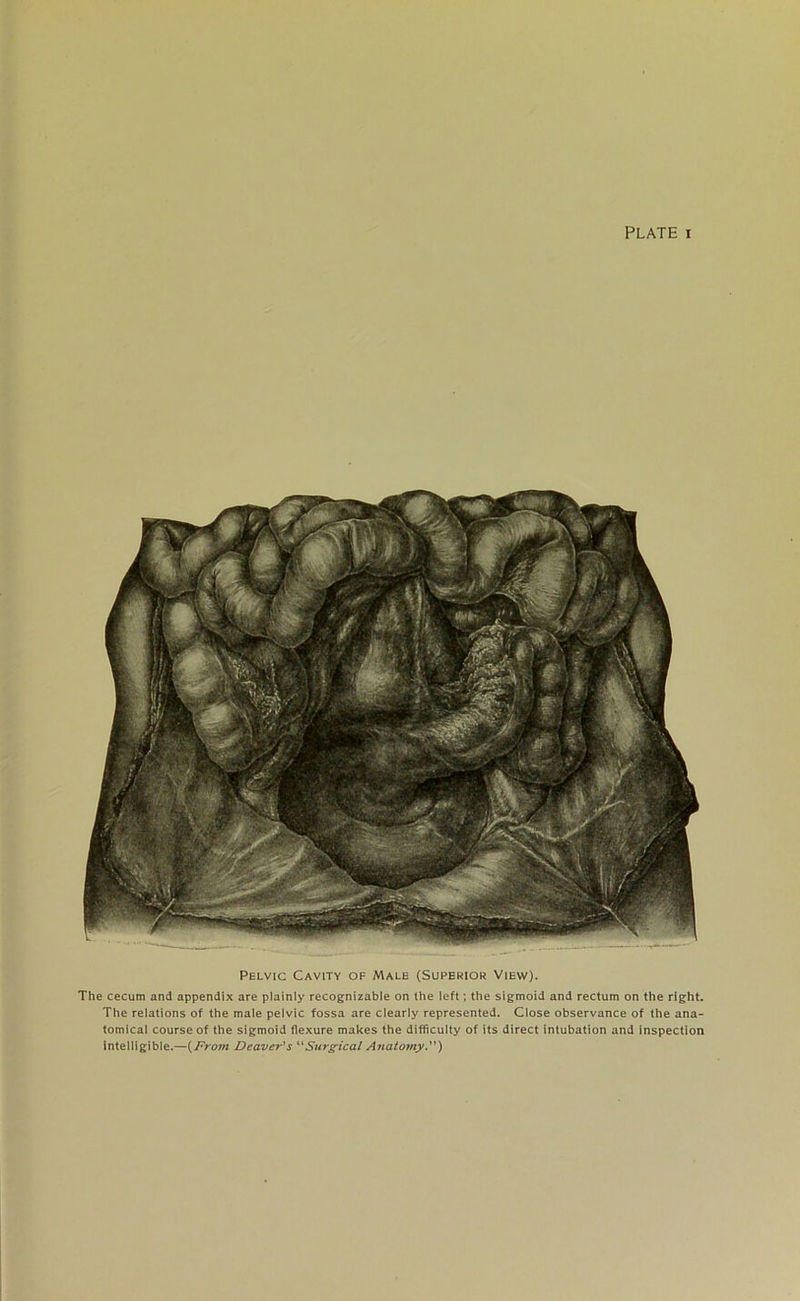 Pelvic Cavity of Male (Superior View). The cecum and appendix are plainly recognizable on the left; the sigmoid and rectum on the right. The relations of the male pelvic fossa are clearly represented. Close observance of the ana- tomical course of the sigmoid flexure makes the difficulty of its direct intubation and inspection intelligible.—(From Deaver's “Surgical Anatomy.)