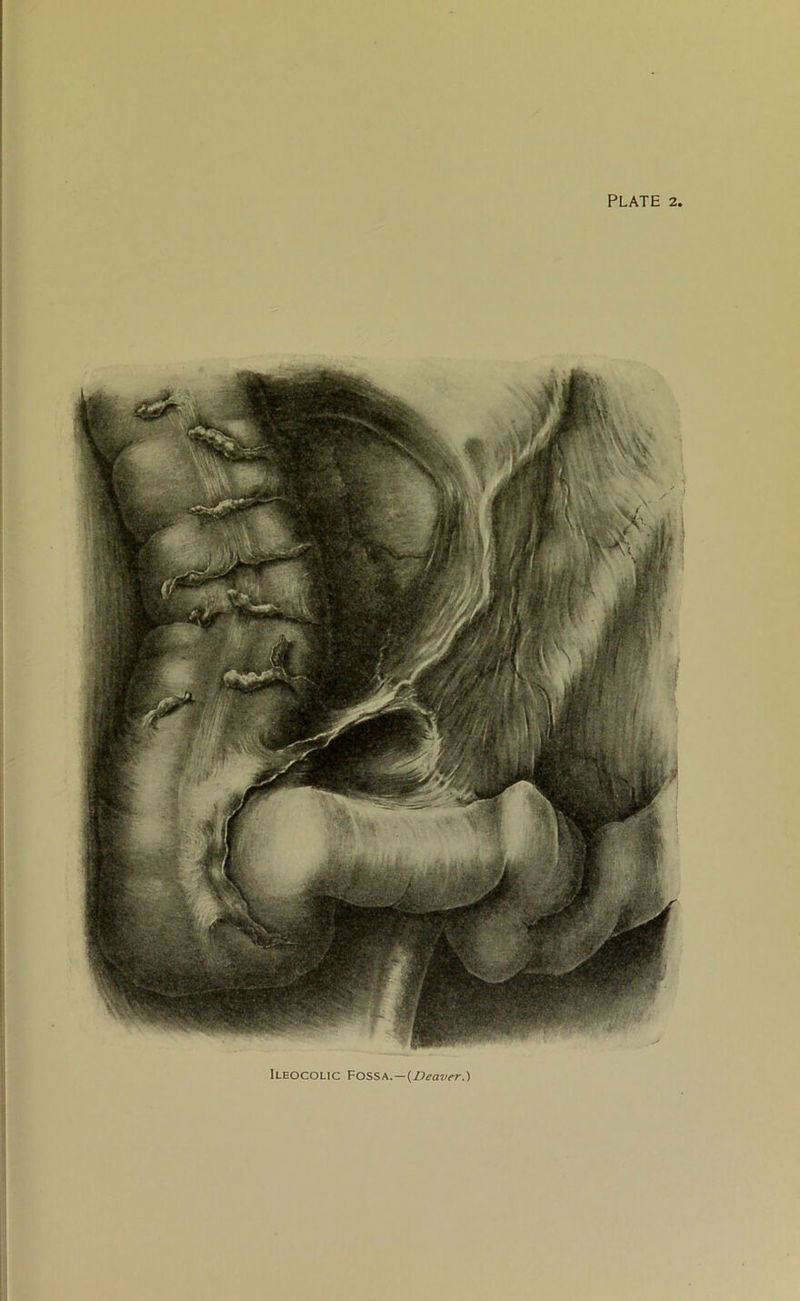 Ileocolic Fossa.—{Denver.)