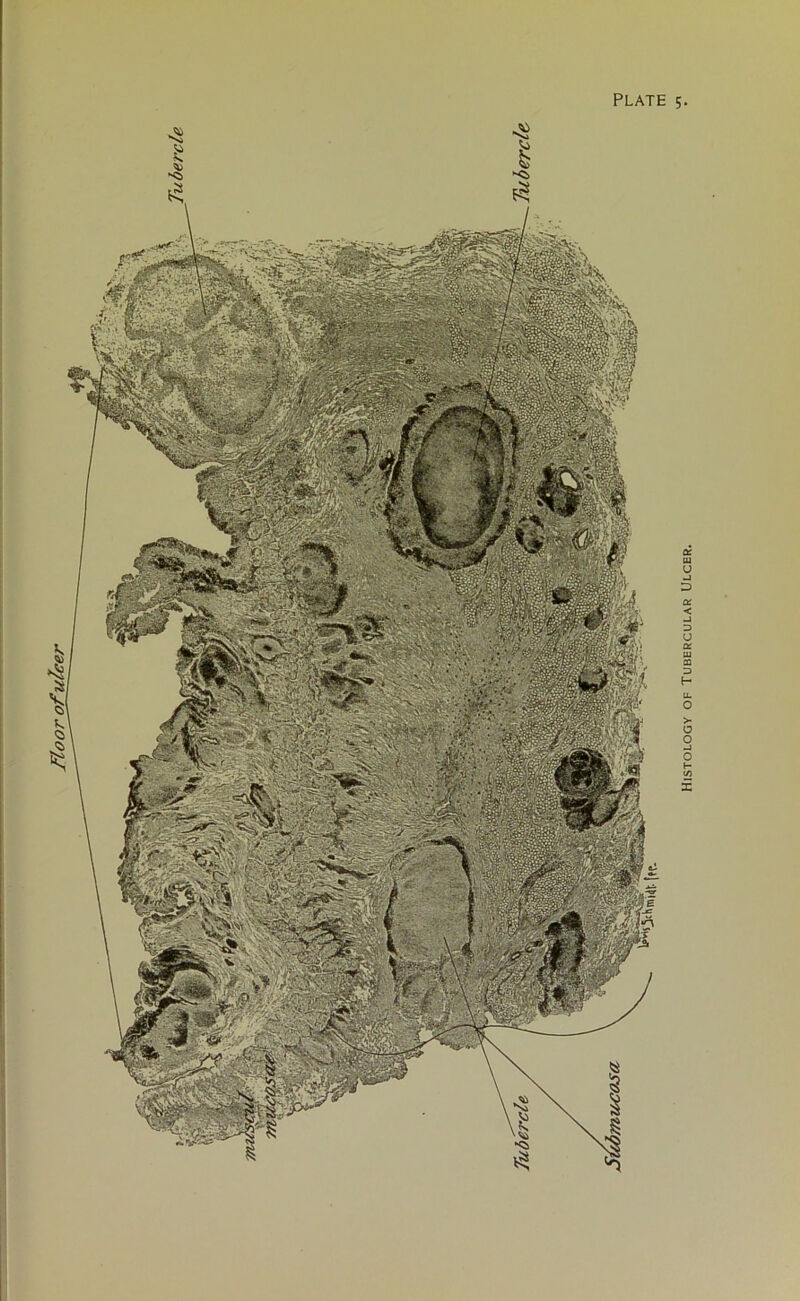 floor of ulcer Histology of Tubercular Ulcer.