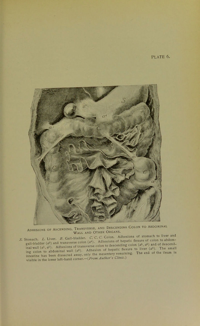 Adhesions of Ascend,ng, Transverse, and Descend,ng Colon to Abdom.nal Wall and Other Organs. 5. Stomach, i. hi,.,. * -rr. errs r. .rr;.: ra=. ” siir > visible in the lower left-hand corner .-(From Author s Chmc.) The small of the ileum is