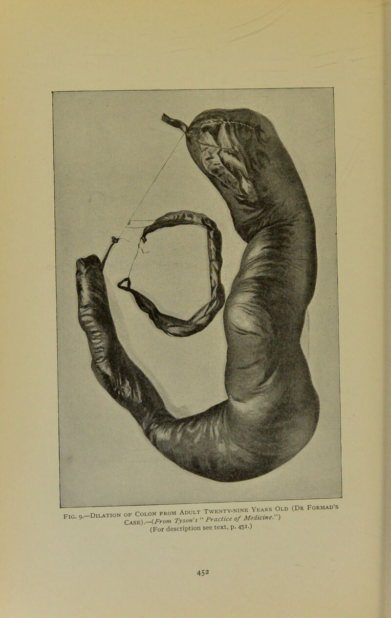 g Dilation ok Colon prom Adult Twenty-nineYears old t- — • 9> DlLAT,ON case).—{From Tyson’s “ Practice of Medicine. ) ivr.r Hpscriotion see text, p. 451)