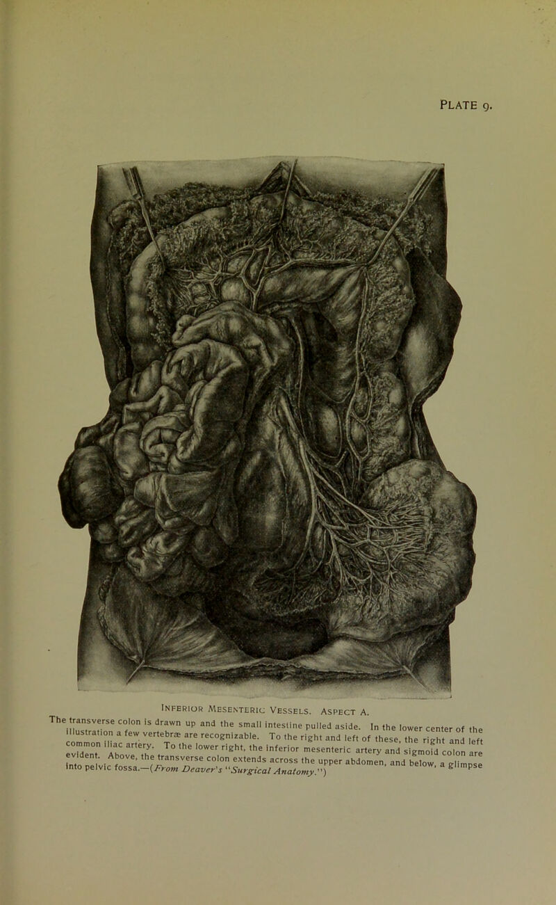 Inferior Mesenteric Vessels. Aspect A. The,rrre C0,'°n iS drawn UP and ,he smal1 intesline Pul,ed aside. > 'he lower center of the a fe: ver,^ra' are -cognizable. To the right and left of these, the right and eft common iliac artery. To the lower right, the inferior mesenteric artery and sigmofd coion are into ne 'vie f°Ve' ,h*'ransverse colon extends 'he upper abdomen, and below, a glimpse into pelvic fossa. (From Deaver's Surgical Anatomy.) S P