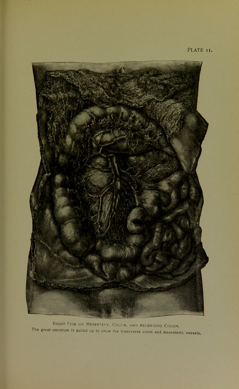 Right Tide of Mesentety, Cecl ai, and Ascending Colon. The great omentum is pulieJ up to show the transverse colon and mesenteric vessels,