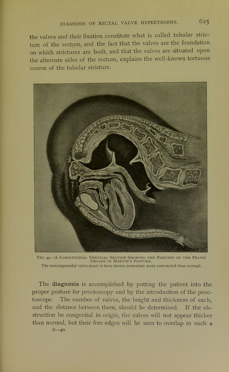 the valves and their fixation constitute what is called tubular stric- ture of the rectum, and the fact that the valves are the foundation on which strictures are built, and that the valves are situated upon the alternate sides of the rectum, explains the well-known tortuous course of the tubular stricture. Fig. 44.—A Longitudinal Vertical Section Showing the Position of the Pelvic Organs in Martin’s Posture. The rectosigmoidal valve-strait is here shown somewhat more contracted than normal. The diagnosis is accomplished by putting the patient into the proper posture for proctoscopy and by the introduction of the proc- toscope. The number of valves, the height and thickness of each, and the distance between them, should be determined. If the ob- struction be congenital in origin, the valves will not appear thicker than normal, but their free edges will be seen to overlap in such a a—40