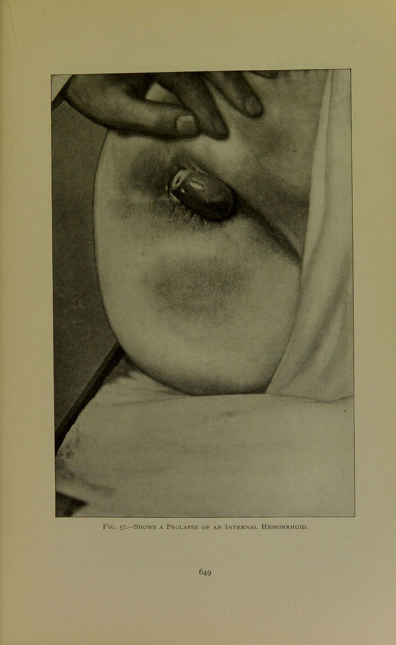 Fig. 57.—Shows a Prolapse of an Internal Hemorrhoid.