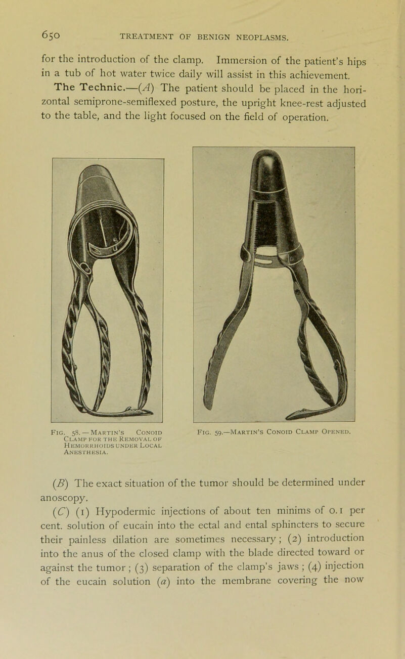 for the introduction of the clamp. Immersion of the patient’s hips in a tub of hot water twice daily will assist in this achievement. The Technic.—(A) The patient should be placed in the hori- zontal semiprone-semiflexed posture, the upright knee-rest adjusted to the table, and the light focused on the field of operation. Fig. 58. — Martin’s Conoid Fig. 59.—Martin’s Conoid Clamp Opened. Clamp for the Removal of Hemorrhoids under Local Anesthesia. (.B) The exact situation of the tumor should be determined under anoscopy. (C) (1) Hypodermic injections of about ten minims of o. I per cent, solution of eucain into the ectal and ental sphincters to secure their painless dilation are sometimes necessary; (2) introduction into the anus of the closed clamp with the blade directed toward or against the tumor ; (3) separation of the clamp’s jaws ; (4) injection of the eucain solution («) into the membrane covering the now