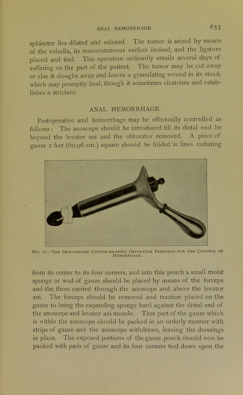 sphincter lies dilated and relaxed. The tumor is seized by means of the volsella, its mucocutaneous surface incised, and the ligature placed and tied. This operation ordinarily entails several days of suffering on the part of the patient. The tumor may be cut away or else it sloughs away and leaves a granulating wound in its stead, which may promptly heal, though it sometimes cicatrizes and estab- lishes a stricture. ANAL HEMORRHAGE. Postoperative anal hemorrhage may be effectually controlled as follows : The anoscope should be introduced till its distal end be beyond the levator ani and the obturator removed. A piece of gauze 2 feet (60.96 cm.) square should be folded in lines radiating Fig. 61.—The Proctoscope Cotton-wrapped Obturator Prepared for the Control of Hemorrhage. from its center to its four corners, and into this pouch a small moist sponge or wad of gauze should be placed by means of the forceps and the three carried through the anoscope and above the levator ani. The forceps should be removed and traction placed on the gauze to bring the expanding sponge hard against the distal end of the anoscope and levator ani muscle. That part of the gauze which is within the anoscope should be packed in an orderly manner with strips of gauze and the anoscope withdrawn, leaving the dressings in place. The exposed portions of the gauze pouch should now be packed with pads of gauze and its four corners tied down upon the