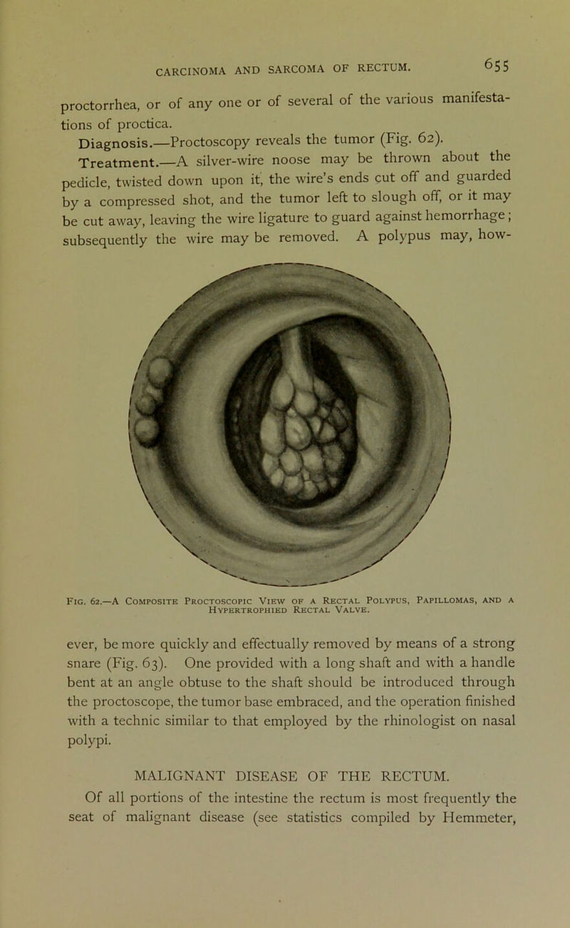 proctorrhea, or of any one or of several of the various manifesta- tions of proctica. Diagnosis.—Proctoscopy reveals the tumor (Fig. 62). Treatment.—A silver-wire noose may be thrown about the pedicle, twisted down upon it, the wire’s ends cut off and guarded by a compressed shot, and the tumor left to slough off, or it may be cut away, leaving the wire ligature to guard against hemorrhage; subsequently the wire may be removed. A polypus may, how- Fig. 62.—A Composite Proctoscopic View of a Rectal Polypus, Papillomas, and a Hypertrophied Rectal Valve. ever, be more quickly and effectually removed by means of a strong snare (Fig. 63). One provided with a long shaft and with a handle bent at an angle obtuse to the shaft should be introduced through the proctoscope, the tumor base embraced, and the operation finished with a technic similar to that employed by the rhinologist on nasal polypi. MALIGNANT DISEASE OF THE RECTUM. Of all portions of the intestine the rectum is most frequently the seat of malignant disease (see statistics compiled by Hemmeter,