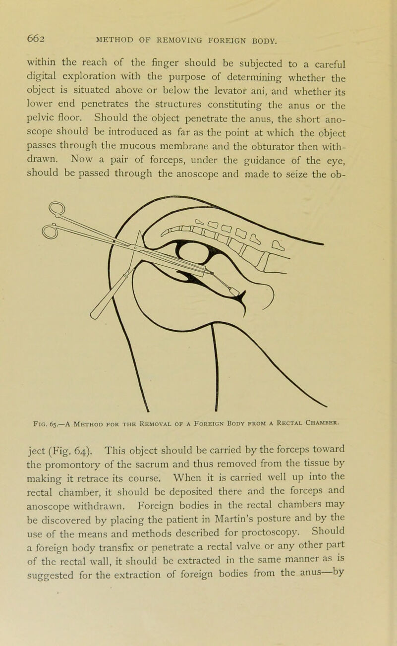 METHOD OF REMOVING FOREIGN BODY. within the reach of the finger should be subjected to a careful digital exploration with the purpose of determining whether the object is situated above or below the levator ani, and whether its lower end penetrates the structures constituting the anus or the pelvic floor. Should the object penetrate the anus, the short ano- scope should be introduced as far as the point at which the object passes through the mucous membrane and the obturator then with- drawn. Now a pair of forceps, under the guidance of the eye, should be passed through the anoscope and made to seize the ob- Fig. 65.—A Method for the Removal of a Foreign Body from a Rectal Chamber. ject (Fig. 64). This object should be carried by the forceps toward the promontory of the sacrum and thus removed from the tissue by making it retrace its course. When it is carried well up into the rectal chamber, it should be deposited there and the forceps and anoscope withdrawn. Foreign bodies in the rectal chambers may be discovered by placing the patient in Martin’s posture and by the use of the means and methods described for proctoscopy. Should a foreign body transfix or penetrate a rectal valve or any other part of the rectal wall, it should be extracted in the same manner as is suggested for the extraction of foreign bodies from the anus by