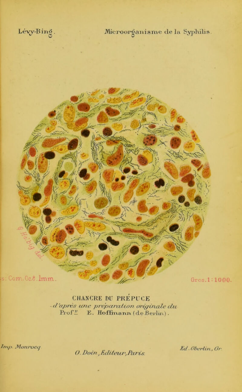 CHANCRE DU PREPUCE (l'après une préparation originale du Pioi’A' E. Hoilina Tin ( de-Berlin ) . 1000. l'rnp. Monrocg O. Doin, Editent',Parût Eit. Oberlin, Or