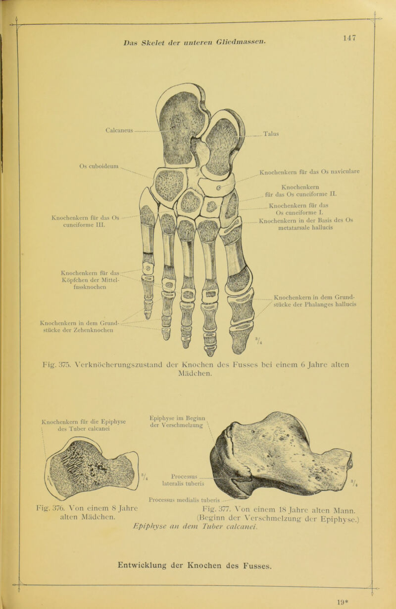 Calcaneus Talus Knochenkern für das Os naviculare Knochenkern für das Os cuneiforme II. Os cuboideum Knochenkern für das Os cuneiforme III. Knochenkern für das Os cuneiforme I. - Knochenkern in der Basis des Os metatarsale hallucis Knochenkern für das:; Köpfchen der Mittel- fussknochen Knochenkern in dem Grund- stücke der Zehenknochen .... Knochenkern in dem Grund- /' stücke der Phalanges hallucis Fig'. 375. Verknöcherungszustand der Knochen des Fusses bei einem 6 Jahre alten Mädchen. Knochenkern für die Epiphyse S des Tuber calcanei / Epiphyse im Beginn der Verschmelzung \ Processus medialis tuberis - Processus lateralis tuberis rig. 3/6. Von einem 8 Jahre alten Mädchen. Epiphyse an dem Tuber calcanei Fig. 377. Von einem 18 Jahre alten Mann. (Beginn der Verschmelzung der Epiphyse.)