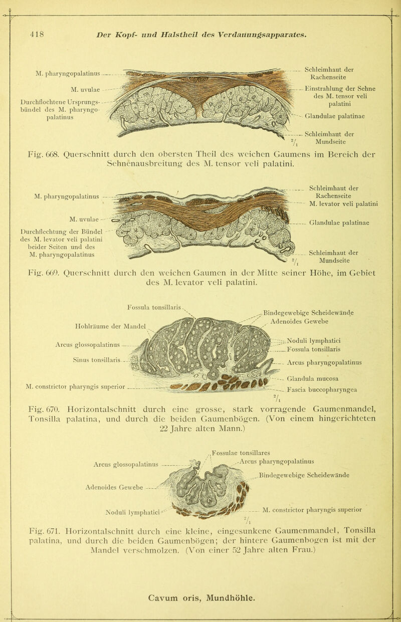 M. pharyngopalatinus M. uvulae Durchflochtene Ursprungs- bündel des M. pharyngo- palatinus — Schleimhaut der Rachenseite — Einstrahlung der Sehne des M. tensor veli palatini -- Glandulae palatinae — Schleimhaut der Mundseite Fig. 668. Querschnitt durch den obersten Theil des weichen Gaumens im Bereich der Sehnenausbreitung des M. tensor veli palatini. M. uvulae M. pharyngopalatinus Durchflechtung der Bündel des M. levator veli palatini beider Seiten und des M. pharyngopalatinus Schleimhaut der Rachenseite M. levator veli palatini Glandulae palatinae Schleimhaut der Mundseite Fig. 669. Querschnitt durch den weichen Gaumen in der Mitte seiner Höhe, im Gebiet des M. levator veli palatini. Fossula tonsillaris Hohlräume der Mandel Arcus glossopalatinus Sinus tonsillaris.. M. constrictor pharyngis superior Bindegewebige Scheidewände Adenoides Gewebe oduli lymphatici Fossula tonsillaris Arcus pharyngopalatinus Glandula mucosa Fascia buccopharyngea Fig. 670. Horizontalschnitt durch eine grosse, stark vorragende Gaumenmandel, Tonsilla palatina, und durch die beiden Gaumenbögen. (Von einem hingerichteten 22 Jahre alten Mann.) Arcus glossopalatinus Adenoides Gewebe Fossulae tonsillares -Arcus pharyngopalatinus Noduli lymphatici- Bindegewebige Scheidewände M. constrictor pharyngis superior Fig. 671. Horizontalschnitt durch eine kleine, eingesunkene Gaumenmandel, Tonsilla palatina, und durch die beiden Gaumenbögen; der hintere Gaumenbogen ist mit der Mandel verschmolzen. (Von einer 52 Jahre alten Frau.) A.