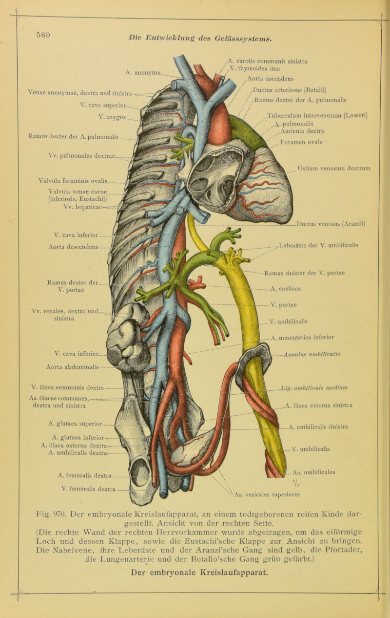 A. anonyma___ Venae anonymae, dextra und sinistra V. cava superior-_. V. azygos Ramus dexter der A. pulmonalis Vv. pulmonales d A. carotis communis sinistra V. thyreoidea ima , Aorta ascendens .Ductus arteriosus (Botalli) / /Ramus dexter der A. pulmonalis Tuberculum intervenosum (Loweri) ,A- pulmonalis .Auricula dextra Foramen ovale V. cava inferior- Aorta descendens A. femoralis dextra- V. femoralis dextra Ductus venosus (Arantii) -.Leberäste der V. umbilicalis -Ramus sinister der V. portae A. coeliaca V. portae V. umbilicalis A. mesenterica inferior Annulus umbilicalis Valvula foraminis ovalis Ramus dexter der V. portae Vv. renales, dextra und sinistra V. cava inferior Aorta abdominalis— Ostium venosum dextrum —Lig. umbilicale medium A. iliaca externa sinistra - A. umbilicalis sinistra —V. umbilicalis W Aa. umbilicales 7, Aa. vesicales superiores Valvula venae cavae (inferioris, Eustachii) Vv. hepaticae V. iliaca communis dextra Aa. iliacae communes, dextra und sinistra A. glutaea superior A. glutaea inferior A. iliaca externa dextra A. umbilicalis d Fig. 970. Der embryonale Kreislaufapparat, an einem todtgeborenen reifen Kinde dar- gestellt. Ansicht von der rechten Seite. (Die rechte Wand der rechten Herzvorkammer wurde abgetragen, um das eiförmige Loch und dessen Klappe, sowie die Eustachische Klappe zur Ansicht zu bringen. Die Nabelvene, ihre Leberäste und der Aranzi’sche Gang sind gelb, die Pfortader, die Lungenarterie und der Botallo’sche Gang grün gefärbt.) Der embryonale Kreislaufapparat.