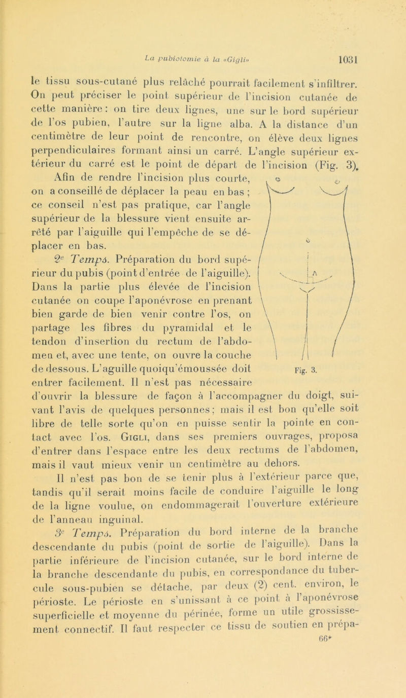 le tissu sous-cutané plus relàché pourrait facilement s’inflltrer. Oh peut pròci sei* le point supérieur de Fincision cutanée de cette manière : on tire deux lignes, une sur le bord supérieur de 1 os pubien, 1 autre sur la ligne alba. A la distance d’un centimètre de leur point de rencontre, on élève deux lignes perpendiculaires formant ainsi un carré. L’angle supérieur ex- térieur du carré est le point de départ de Fincision (Fig. 3). Afìn de rendre Fincision plus courte, on a conseillé de déplacer la peau en bas ; ce conseil n’est pas pratique, car l’angle supérieur de la blessure vient en suite ar- rèté par l aiguille qui Fempèche de se dé- placer en bas. 2e Tempó. Préparation du bord supé- rieur du pubis (point d’entrée de l’aiguille). Dans la partie plus élevée de Fincision cutanée on coupé Faponévrose en prenant bien garde de bien venir con tre Fos, on partage les fìbres du pyramidal et le tendon d’insertion du rectum de l’abdo- men et, avec une tente, on ouvre la couche de dessous. L'aguille quoiqu'émoussée doit Fig. 3. entrer facilement, 11 n'est pas nécessaire d’ouvrir la blessure de fagon à l accompagner du doigt, sui- vant Favis de quelques personnes; mais il est bon qu’elle soit libre de tede sorte qu’on en puisse sentir la pointe en con- tact avec Fos. Gigli, dans ses premiers ouvrages, proposa d’entrer dans 1 espace entre les deux rectums de 1 abdomen, mais il vaut mieux venir un centimètre au dehors. 11 n’est pas bon de se lenir plus à 1 extérieur parce que, tandis qu ii serait moins facile de conduire l aiguille le long de la ligne voulne, on endommagerait 1 ouverture extérieure de Fanneau inguinal. 3e Tempó. Préparation du bord interne de la branche descendante du pubis (point de sorde de 1 aiguille). Dans la partie inférieure de Fincision cutanée, sur le bord interne de la branche descendante du pubis, en correspondanee du tubei- cule sous-pubien se détache, par deux (2) cent. en\non, le. périoste. Le périoste en s’unissant a ce point a laponéviose superfìcielle et moyenne du périnée, forme un utile grossisse- ment connectif. Il faut respecter ce tissu de soutien en prépa- 66*