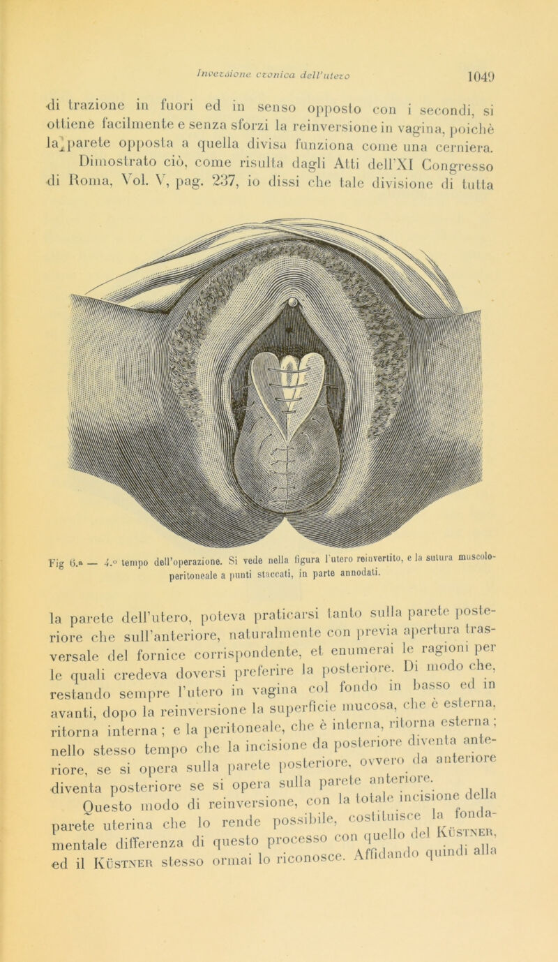 ■di trazione in fuoii ed. in senso opposio con i secondi, si ottiene lacdniente e senza slorzi la reinversione in vagina, poiché la^parete opposta a quella divisa funziona come una cerniera. Dimostrato ciò, come risulta dagli Atti dell'XI Congresso di Roma, \ ol. V, pag. 237, io dissi che tale divisione di tutta Fig tj.a — 4.0 tempo dell’operazione. Si vede nella figura l'utero reinvertito, e la sutura muscolo- peritoneale a punti staccati, in parto annodati. la parete dell’utero, poteva praticarsi tanto sulla parete poste- riore che sull’anteriore, naturalmente con pitviu apeituia lias versale del fornice corrispondente, et enumerai le ragioni pel- le quali credeva doversi preferire la posteriore. Di modo che, restando sempre l’utero in vagina col fondo m basso ed in avanti, dopo la reinversione la superficie mucosa, che e esterna, ritorna interna ; e la peritoneale, che è interna, ritorna esterna, nello stesso tempo che la incisione da posteriore diventa ante- riore, se si opera sulla parete posteriore, ovvero da antenoie diventa posteriore se si opera sulla pan le 'in . , Questo modo di reinversione, con la Iota c incisione de la parete uterina che lo rende possibile, cos'ilu.sceia fonda- mentale differenza di questo processo con quel J