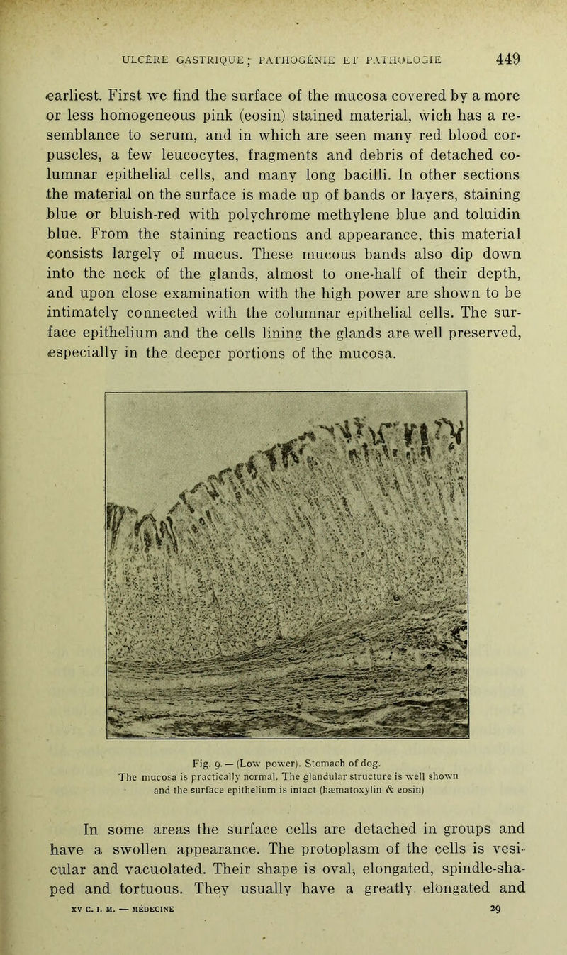 earliest. First we find the surface of the mucosa covered by a more or less homogeneous pink (eosin) stained material, wich has a re- semblance to sérum, and in which are seen many red blood cor- puscles, a fevv leucocytes, fragments and débris of detached co- lumnar épithélial cells, and many long bacilli. In other sections the material on the surface is made up of bands or lavers, staining blue or bluish-red with polychrome methylene blue and toluidin blue. From the staining reactions and appearance, this material consists largely of mucus. These mucous bands also dip down into the neck of the glands, almost to one-half of their depth, and upon close examination with the high power are shown to be intimately connected with the columnar épithélial cells. The sur- face epithelium and the cells lining the glands are well preserved, especially in the deeper portions of the mucosa. Fig. g. — (Low power). Stomach of dog. The mucosa is practically normal. The glandular structure is well showm and the surface epithelium is intact (hæmatoxylin & eosin) In some areas the surface cells are detached in groups and hâve a swollen appearance. The protoplasm of the cells is vesi- cular and vacuolated. Their shape is oval, elongated, spindle-sha- ped and tortuous. They usually hâve a greatly elongated and XV C. I. M. — MÉDECINE 29