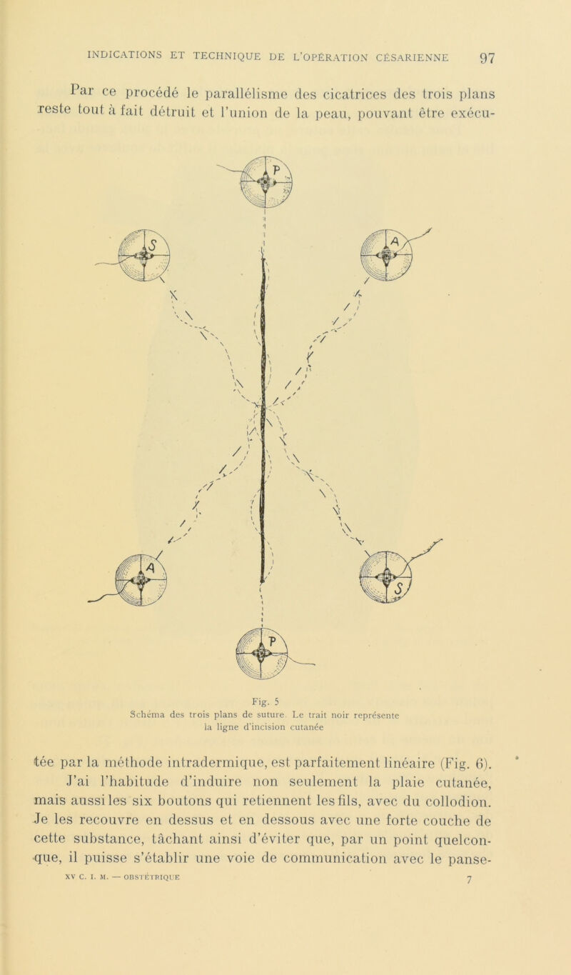 Par ce procédé le parallélisme des cicatrices des trois plans reste tout à fait détruit et l’union de la peau, pouvant être exécu- Fig. 5 Schéma des trois plans de suture. Le trait noir représente la ligne d’incision cutanée tée parla méthode intradermique, est parfaitement linéaire (Fig. 6). J’ai l’habitude d’induire non seulement la plaie cutanée, mais aussi les six boutons qui retiennent les fils, avec du collodion. Je les recouvre en dessus et en dessous avec une forte couche de cette substance, tâchant ainsi d’éviter que, par un point quelcon- que, il puisse s’établir une voie de communication avec le panse- XV C. I. M. — OBSTÉTRIQUE 7