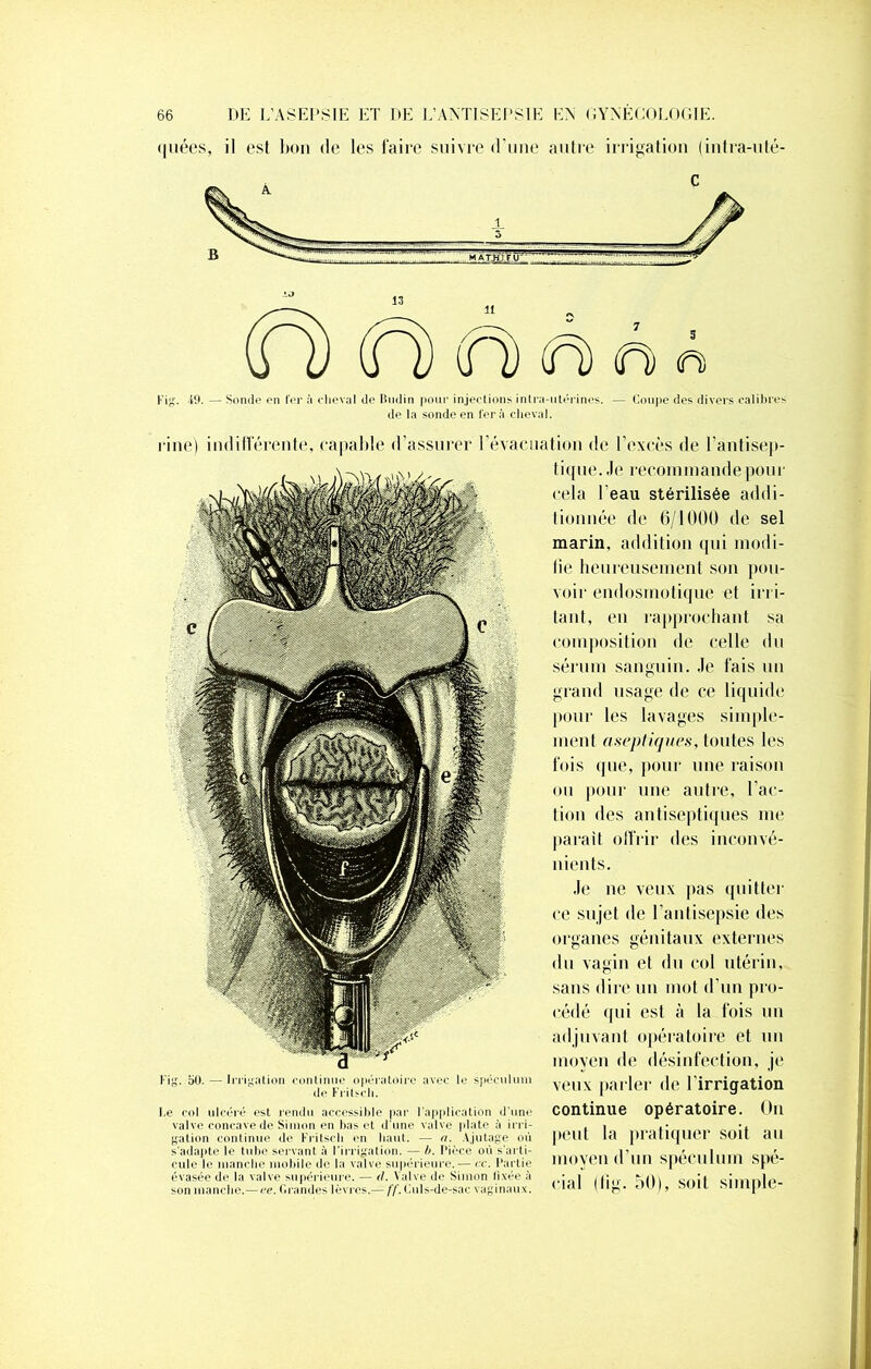 <1 uées, il est bon de les faire suivre d’une autre irrigation (intra-uté- Fig. 19. — Sonde en fer à cheval de Budin pour injections intra-utérines. — Coupe des divers calibres de la sonde en fera cheval. rine) indifférente, capable d’assurer l’évacuation de l’excès de l’antisep- tique . Je recom in ande po u r cela l'eau stérilisée addi- tionnée de 6/1000 de sel marin, addition qui modi- fie heureusement son pou- voir endosmotique et irri- tant, en rapprochant sa composition de celle du sérum sanguin. Je fais un grand usage de ce liquide pour les lavages simple- ment aseptiques, toutes les fois que, pour une raison ou pour une autre, l ac- lion des antiseptiques me parait offrir des inconvé- nients. Je ne veux pas quitter ce sujet de l’antisepsie des organes génitaux externes du vagin et du col utérin, sans dire un mot d’un pro- cédé qui est à la fois un adjuvant opératoire et un moyen de désinfection, je veux parler de l’irrigation continue opératoire. On peut la pratiquer soit au moyen d’un spéculum spé- cial (fîg. 50), soit simple- Fig. 50. — Irrigation continue opératoire avec h* spéculum de Fritsch. Ce col ulcéré est rendu accessible par l’application d’une valve concave de Simon en bas et d’une valve plate à irri- gation continue de Fritsch en haut. — a. Ajutage où s’adapte le tube servant à l'irrigation. — b. Pièce où s’arti- cule le manche mobile de la valve supérieure.— ce. Partie évasée d<* la valve supérieure. — d. Valve de Simon fixée à son manche.—ce. Grandes lèvres.— ff. Culs-de-sac vaginaux.