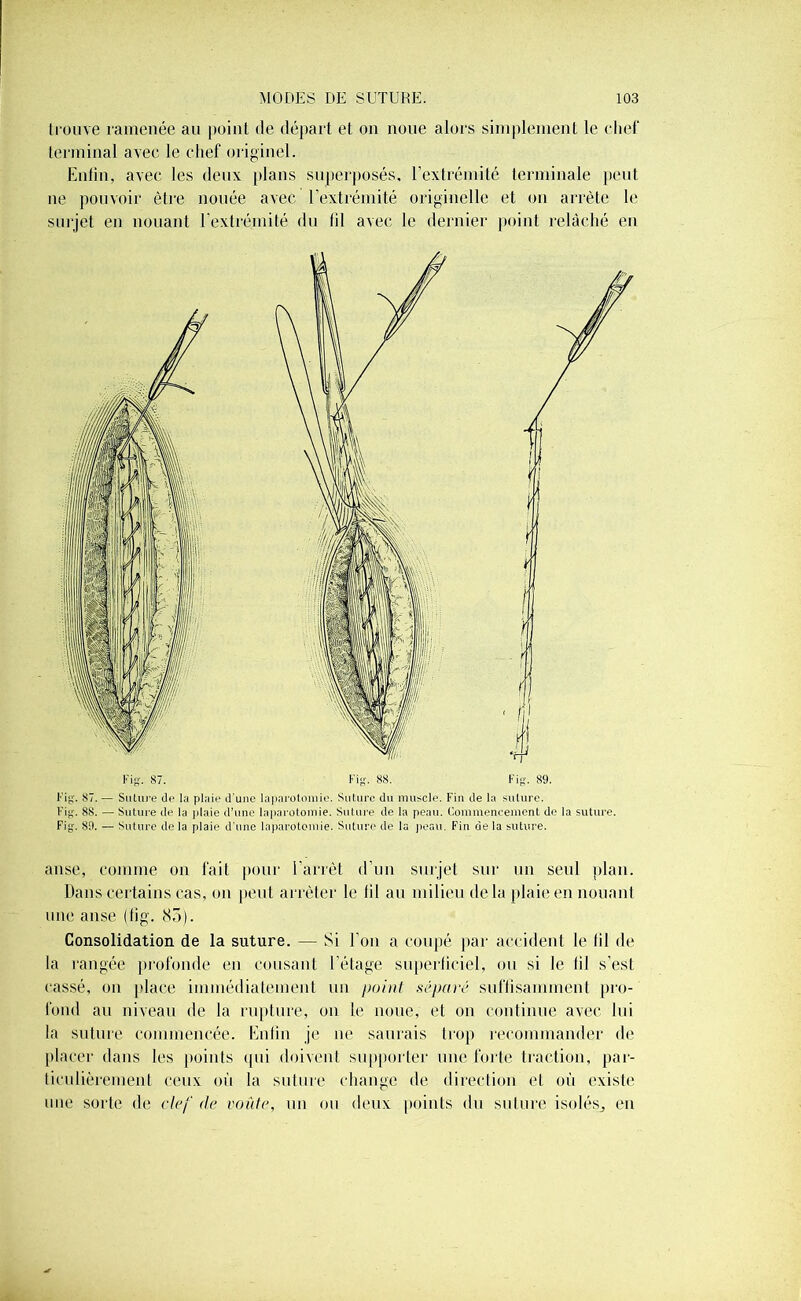 trouve ramenée au point de départ et on noue alors simplement le chef terminal avec le chef originel. Enfin, avec les deux plans superposés, l’extrémité terminale peut ne pouvoir être nouée avec l'extrémité originelle et on arrête le surjet en nouant l’extrémité du fil avec le dernier point relâché en Fig'. 87. Fig. 88. Fig. 89. Fig. 87. — Suture de la plaie d'une laparotomie. Suture du muscle. Fin de la suture. Fig. 88. — Suture de la plaie d’une laparotomie. Suture de la peau. Commencement de la suture. Fig. 89. — Suture de la plaie d'une laparotomie. Suture de la peau. Fin de la suture. anse, comme on fait pour l'arrêt d’un surjet sur un seul plan. Dans certains cas, on peut arrêter le lil au milieu de la plaie en nouant une anse (lig. 85). Consolidation de la suture. — Si l’on a coupé par accident le lil de la rangée profonde en cousant l’étage superficiel, ou si le lil s’est cassé, on place immédiatement un point séparé suffisamment pro- fond au niveau de la rupture, on le noue, et on continue avec lui la suture commencée. Enfin je ne saurais trop recommander de placer dans les points qui doivent supporter une forte traction, par- ticulièrement ceux où la suture change de direction et où existe une sorte de clef de voûte, un ou deux points du suture isolés, en