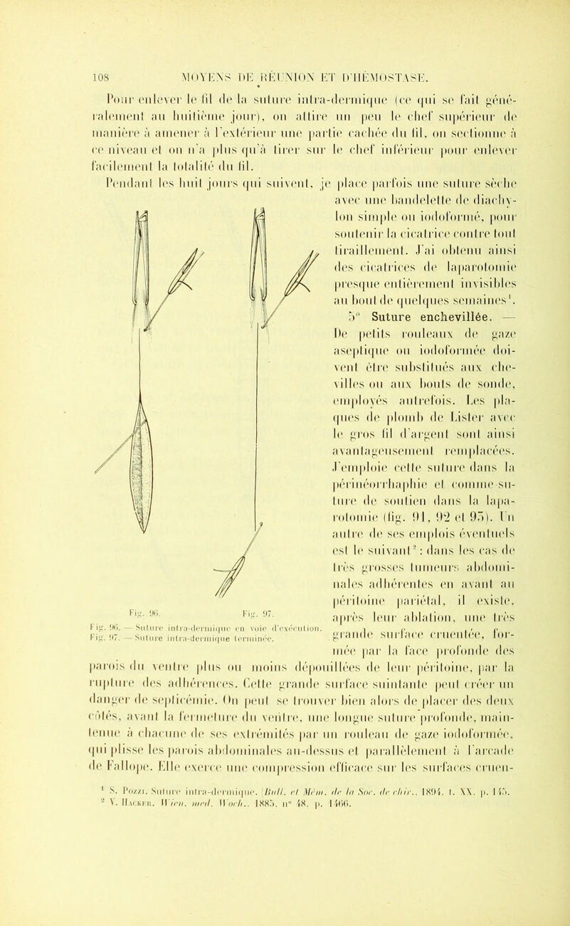 Pour enlever le lil de la sulure inlra-dernii(|iie (ce qui se fail géné- ralement au huilième jour), on al 1 ire un peu le chef supérieur de manière à amener à l’extérieur une parlie cachée du lil. on scclionne à ce niveau el on n'a plus qu’à tirer sur le chef inférieur pour enlever facilement la totalité du lil. Pendant les huit jours qui suivent, je place parfois une sulure sèche avec une bandelette de diachy- lon simple ou iodofnrmé. pour soulenir la cicatrice contre tout tiraillement. J'ai obtenu ainsi des cicatrices (h* laparotomie presque entièrement invisibles au bout de quelques semaines1. 5° Suture enchevillée. — De petits rouleaux de gaze aseptique ou iodoformée doi- vent être substitués aux cbe- \ illes ou aux bonis (h* sonde, employés autrefois. Les pla- ques de plomb de Lister avec le gros lil d’argent sont ainsi avantageusement remplacées. J'emploie cette suture dans la périnéorrbaphie el comme su- ture de soutien dans la lapa- rotomie (lig. 91, 9*2 et 9ô). I n aulre de ses emplois évenlmds est le suivantj : dans les cas de Dès grosses tumeurs abdomi- nales adhérentes en avant au péritoine pariétal, il existe, après leur ablation, une très l- ifr. îm>. — Sulure inliy-dermiquo en voie d'exécution. i <• . , ,. l-'iir. <17.— Sulure i..lr,i-denni<|.ie terminée. grande SUI'laCC CriinileC, tor- mée par la face profonde des parois du ventre plus ou moins dépouillées de leur péritoine, par la rupture des adhérences. Cette grande surface suintante peut créer un danger de septicémie. <hi peut se trouver bien alors de placer des deux cotes, avant la fermeture du ventre, une longue sulure profonde, main- tenue a chacune de ses extrémités par un rouleau de gaze iodoformée, (pii plisse les parois abdominales au-dessus et parallèlement à l’arcade de Fallope. Elle exerce une compression efficace sur les surfaces cruen- 1 S. Pozzi. Sulure inlra-dermique. liiill. H Mrm. de la Soc. de chic.. 1894. I. \\. p. 145. ■ \. Hacker. Il irn. med. Woch.. 1885. n° 48. p. 4460. Fi»'. 96. Fi». 97.