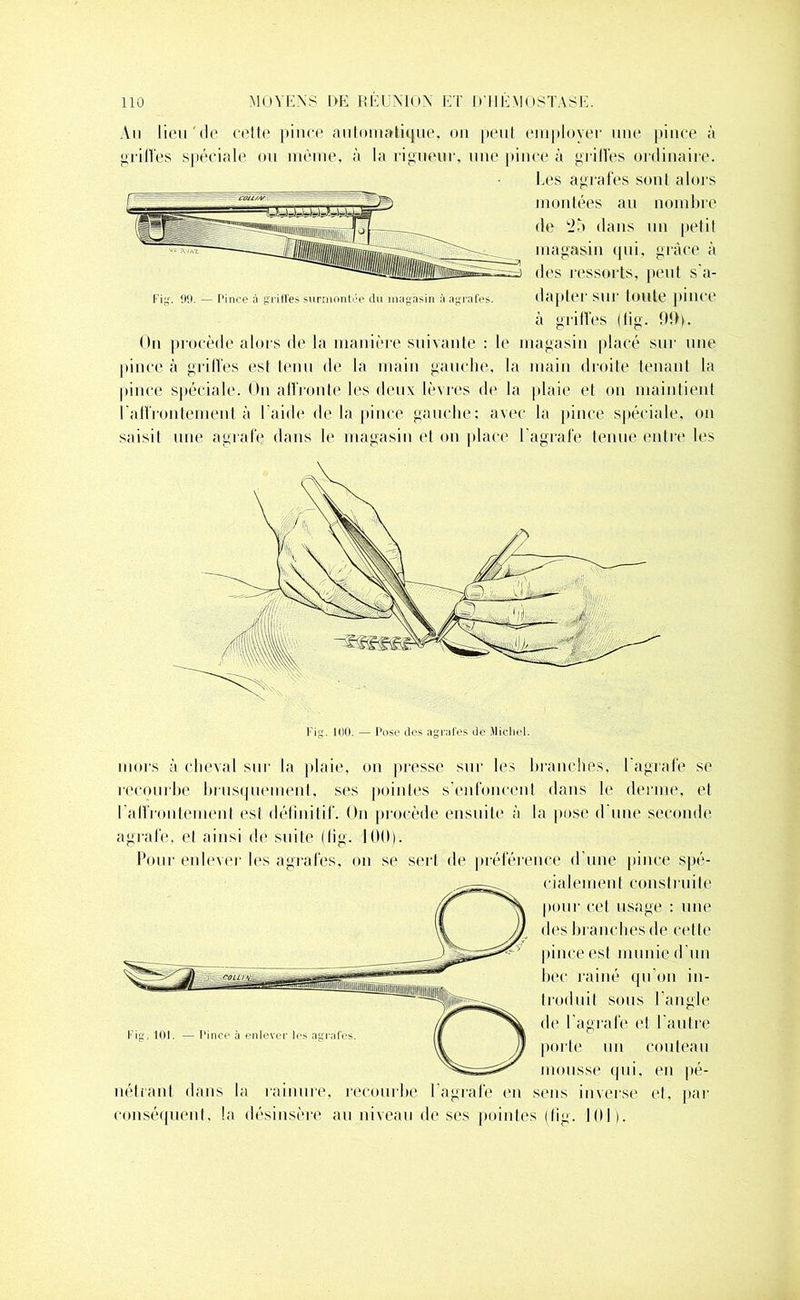 An lieu Aie cette pince automatique, on peut employer une pince à grilles spéciale ou môme, à la rigueur, une pince à griffes ordinaire. Les agrafes sont alors montées au nombre de 25 dans un petit magasin qui, grâce à des ressorts, peut s'a- Fig. 99. — Pince à griffes surmontée du magasin à agrafes. dapter sur toute pince à griffes (fig. 99p On procède alors de la manière suivante : le magasin placé sur une pince à griffes est tenu de la main gauche, la main droite tenant la pince spéciale. On affronte les deux lèvres de la plaie et on maintient l’affrontement à l'aide delà pince gauche; avec la pince spéciale, on saisit um“ agrafe dans le magasin et on place l’agrafe tenue entre Ion Fig. 100. — Pose des agrafes de Michel. mors à cheval sur la plaie, on presse sur les branches, l’agrafe se recourbe brusquement, ses pointes s’enfoncent dans le derme, et l'affrontement esi définitif. On procède ensuite à la pose d’une seconde agrafe, et ainsi de suite (fig. 100). Pour enlever les agrafes, on se sert de préférence d’une pince spé- rig. nu. Pince à enlever les agrafes. nétrant dans la rainure conséquent, la désinsère au niveau de ses pointes (lig. cialement construite pour cet usage : une dos branches de cette pince est munie d’un bec rainé qu'on in- troduit sous l'angle de l’agrafe (“I l'autre porte un couteau mousse qui, en pé- recourbe I agrafe en sens inverse et, par ).