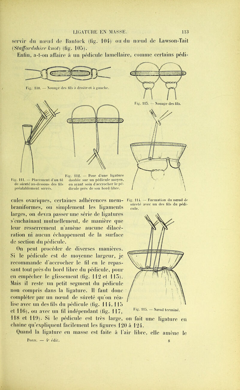 servir du nœud de Bantock (lig. 101) ou du nœud de Lawson-Tait (Staffordsliire knot) (lig. 105). Enfin, a-t-on affaire à un pédicule lamellaire, comme certains pédi- Fig. 110. — Nouage des (ils à droite et à gauche. préalablement serrés. dicule près de son bord libre. cules ovariques, certaines adhérences ment- Fig. m. — Formation du nœud de .... . . .1,- , sûreté avec un des lils du pédi- hranilormes, ou simplement tes ligaments Cuie. larges, on devra passer une série de ligatures s’enchaînant mutuellement, de manière que leur resserrement n'amène aucune dilacé- ration ni aucun échappement de la surface de section du pédicule. On peut procéder de diverses manières. Si le pédicule est de moyenne largeur, je recommande d’accrocher le fil en le repas- sant tout près du bord libre du pédicule, pour en empêcher le glissement (fig. 112 et 115). Mais il reste un petit segment du pédicule non compris dans la ligature. 11 faut donc compléter par un nœud de sûreté qu’on réa- lise avec un des lils du pédicule (lig. 114,115 et 116), ou avec un fil indépendant (lig. 117, 118 et 119). Si le pédicule est très large, on fait une ligature en chaîne qu’expliquent facilement les ligures 120 à 124. Quand la ligature en masse est faite à l’air libre, elle amène le Pozzi. — 4e édit. 115. — Nœud terminé. 8