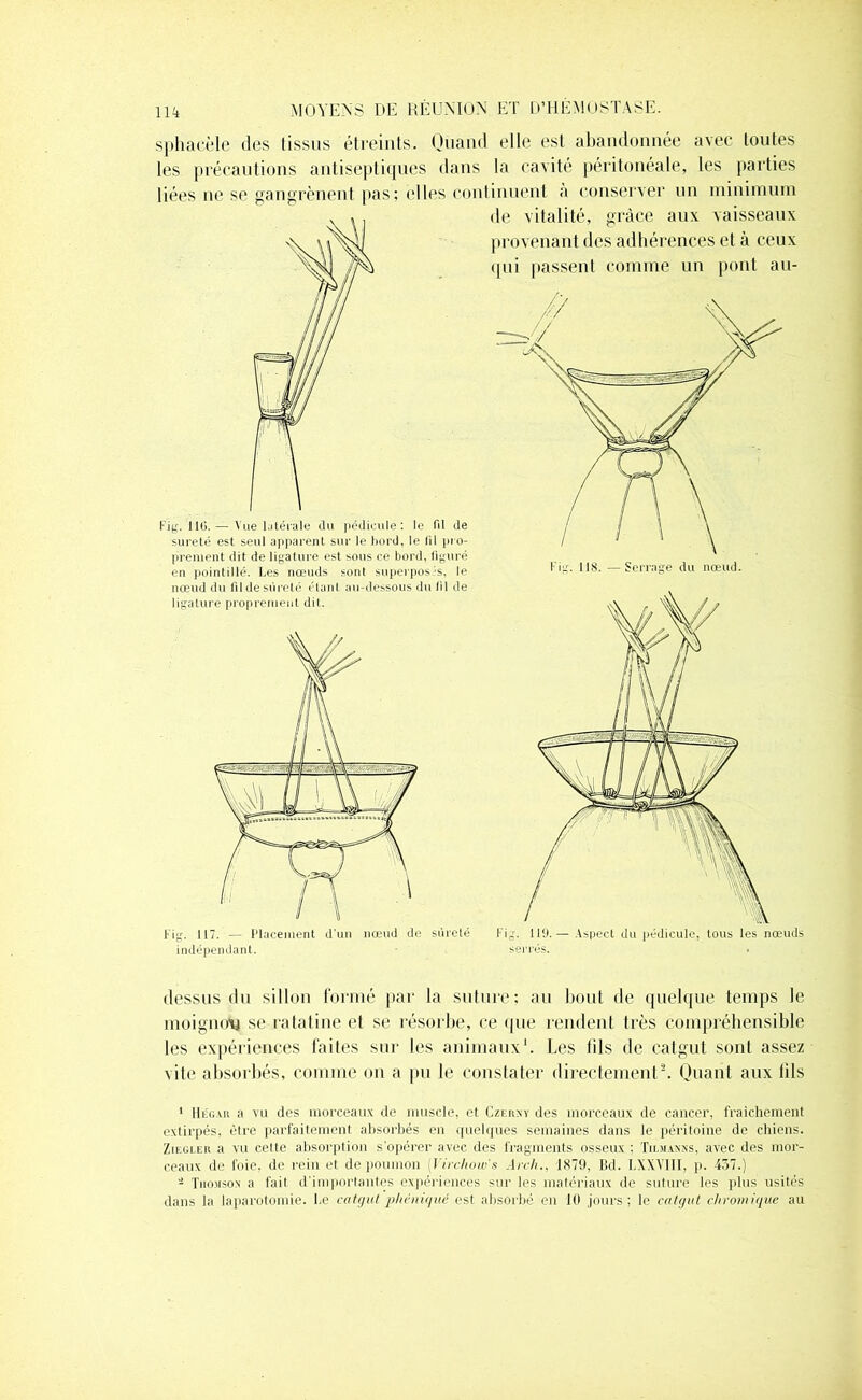sphacèle des tissus étreints. Quand elle est abandonnée avec toutes les précautions antiseptiques dans la cavité péritonéale, les parties liées ne se gangrènent pas; (‘lies continuent à conserver un minimum de vitalité, grâce aux vaisseaux provenant des adhérences et à ceux qui passent comme un pont au- Fig. lltî. — Vue latérale (lu pédicule: le Fil de sûreté est seul apparent sur le bord, le (il pro- prement dit de ligature est sous ce bord, figuré en pointillé. Les nœuds sont superposés, le nœud du fil de sûreté étant au-dessous du fil de ligature proprement dit. Fig. 117. — Placement d'un nœud de sûreté indépendant. Fig. 119.— Aspect du pédicule, tous les nœuds serrés. dessus du sillon formé par la suture: au bout de quelque temps le moignotj se ratatine et se résorbe, ce que rendent très compréhensible les expériences faites sur les animaux1. Les fils de catgut sont assez vite absorbés, comme on a pu le constater directement2. Quant aux fils 1 IIég.vr a vu des morceaux de muscle, et Czerny des morceaux de cancer, fraîchement extirpés, être parfaitement absorbés en quelques semaines dans le péritoine de chiens. Ziegler a vu celte absorption s’opérer avec des fragments osseux ; Tidianns, avec des mor- ceaux de foie, de rein et de poumon ('Virchow s Arch., 1879, Bd. I,XXVIII, p. 437.) - Thomson a fait d'importantes expériences sur les matériaux de suture les plus usités dans la laparotomie. Le catgut phéniqué est absorbé en 10 jours; le catgut cliromique au