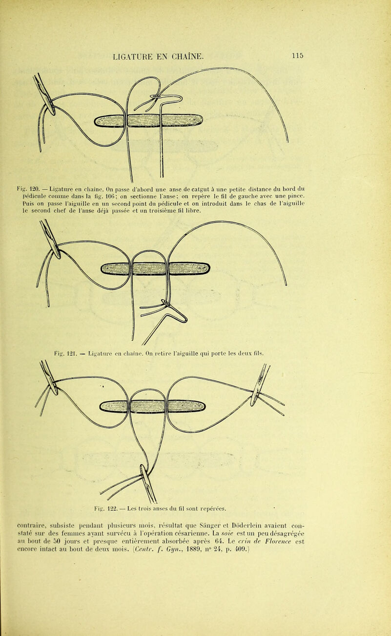 l'ig. 120. —Ligature en cliaine. On passe d’abord une anse de catgut à une petite distance du bord du pédicule comme dans la lîg. 100; on sectionne l'anse; on repère le fil de gauche avec une pince. Puis on passe l’aiguille en un second point du pédicule et on introduit dans le chas de l’aiguille le second chef de l'anse déjà passée et un troisième lil libre. contraire, subsiste pendant plusieurs mois, résultat que Sanger et Dôderlein avaient con- staté sur des femmes ayant survécu à l'opération césarienne. La soie est un peu désagrégée au bout de 50 jours et presque entièrement absorbée après 64. Le crin de Florence est encore intact au bout de deux mois. (Centr. f. Gyn., 1889, n° 24, p. 409.)