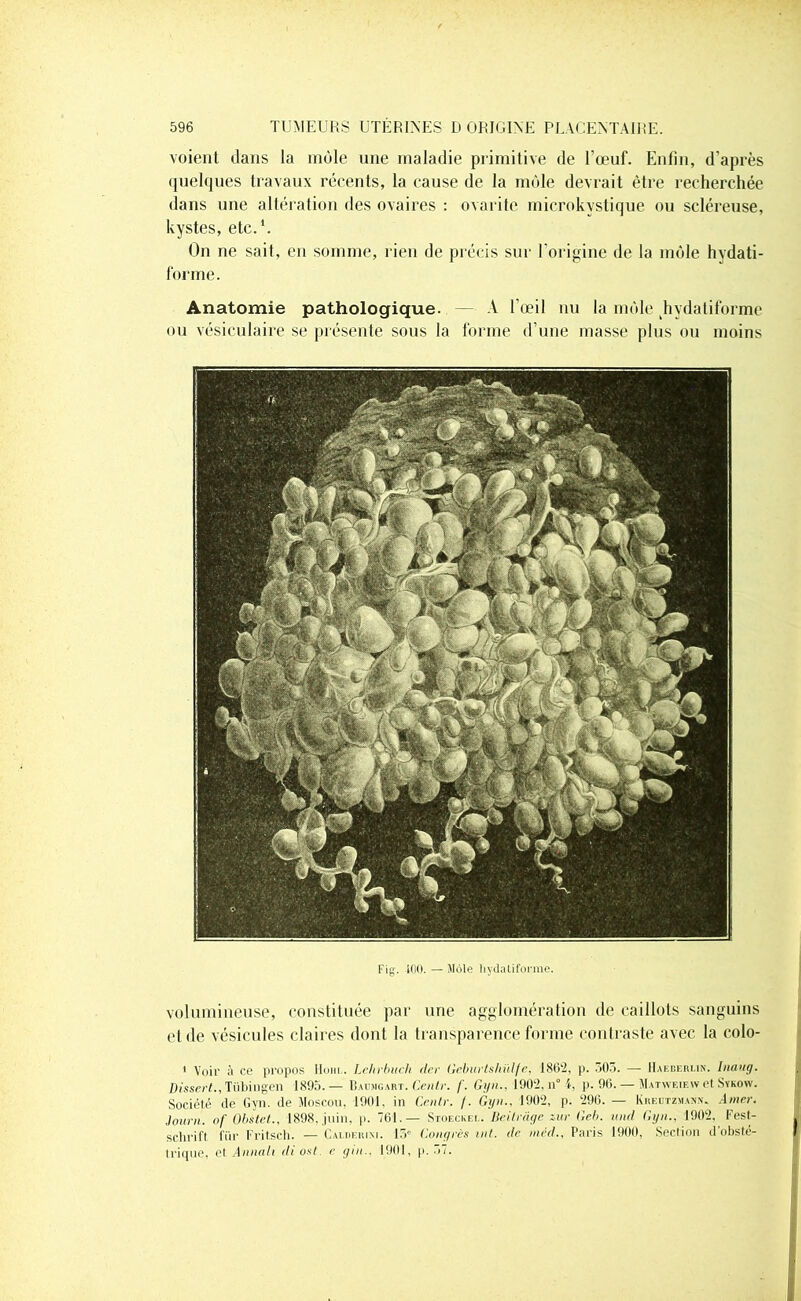 voient dans la înùle une maladie primitive de l’œuf. Enfin, d’après quelques travaux récents, la cause de la môle devrait être recherchée dans une altération des ovaires : ovarite microkystique ou scléreuse, kystes, etc.1. On ne sait, en somme, rien de précis sur l’origine de la môle hydati- forme. Anatomie pathologique. — A l’œil nu la môle hydatiforme ou vésiculaire se présente sous la forme d’une masse plus ou moins Fig. 1(10. — Môle hydatiforme. volumineuse, constituée par une agglomération de caillots sanguins et de vésicules claires dont la transparence forme contraste avec la colo- 1 Voir à ce propos Hom.. Lehrbuch der Geburtshülfe, 1802, p. 503. — Haeberlin. hiang. Dissert., Tübingen 1895.— Baümgart. Centr. /'. Gyn.. 1902, n* 4, p. 96. — Matweiew et Sïkow. Société de Gyn. de Moscou, 1901. in Centr. /. Gyn.. 1902, p. 29(3. — Kredtzmann. Amer. Journ. of Obstet., 1898, juin, p. 761.— Stoeckei.. Beilrâge iur Geb. und Gyn., 1902. Fest- schrift für Fritsch. — Calderim. 15' Congrès inl. de méd., Paris 1900, Section d obsté- trique, et Annali diost. e gin.. 1901, p. 57.