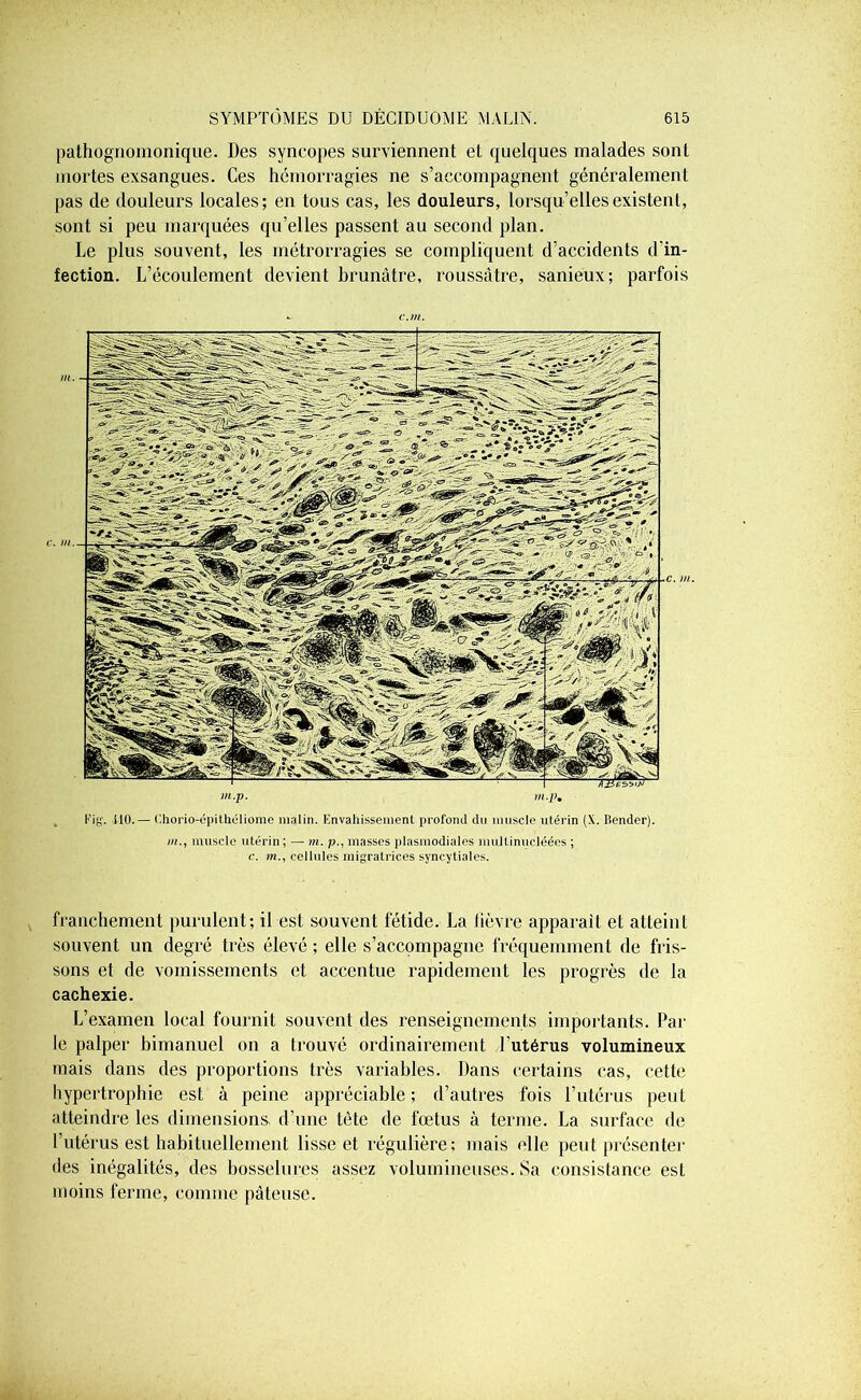 pathognomonique. Des syncopes surviennent et quelques malades sont mortes exsangues. Ces hémorragies ne s’accompagnent généralement pas de douleurs locales; en tous cas, les douleurs, lorsqu’elles existent, sont si peu marquées qu’elles passent au second plan. Le plus souvent, les métrorragies se compliquent d’accidents d'in- fection. L’écoulement devient brunâtre, roussàtre, sanieux; parfois c.m. m.p. m.p. Kig. 410.— Chorio-épithéliome malin, envahissement profond du muscle utérin (X. Bender). ni., muscle utérin; —• m. p., masses plasmodiales mullinucléées ; c. m., cellules migratrices syncytiales. franchement purulent; il est souvent fétide. La lièvre apparaît et atteint souvent un degré très élevé ; elle s’accompagne fréquemment de fris- sons et de vomissements et accentue rapidement les progrès de la cachexie. L’examen local fournit souvent des renseignements importants. Par le palper bimanuel on a trouvé ordinairement l’utérus volumineux mais dans des proportions très variables. Dans certains cas, cette hypertrophie est à peine appréciable ; d’autres fois l’utérus peut atteindre les dimensions, d’une tête de fœtus à terme. La surface de l’utérus est habituellement lisse et régulière; mais elle peut présenter des inégalités, des bosselures assez volumineuses. Sa consistance est moins ferme, comme pâteuse.