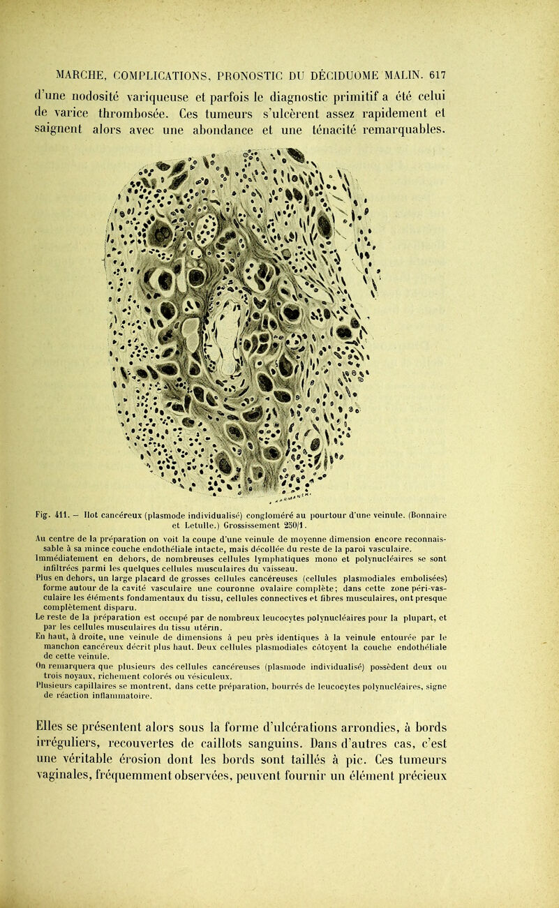 •l’une nodosité variqueuse et parfois le diagnostic primitif a été celui de varice thrombosée. Ces tumeurs s’ulcèrent assez rapidement et saignent alors avec une abondance et une ténacité remarquables. Fig. 411. - Ilot cancéreux (plasmode individualisé) congloméré au pourtour d'une veinule. (Bonnaire et Letulle.) Grossissement 250/1. Au centre de la préparation on voit la coupe d'une veinule de moyenne dimension encore reconnais- sable à sa mince couche endothéliale intacte, mais décollée du reste de la paroi vasculaire. Immédiatement en dehors, de nombreuses cellules lymphatiques mono et polynucléaires se sont infiltrées parmi les quelques cellules musculaires du vaisseau. Plus en dehors, un large placard de grosses cellules cancéreuses (cellules plasmodiales embolisées) forme autour de la cavité vasculaire une couronne ovalaire complète; dans cette zone péri-vas- culaire les éléments fondamentaux du tissu, cellules connectives et fibres musculaires, ont presque complètement disparu. Le reste de la préparation est occupé par de nombreux leucocytes polynucléaires pour la plupart, et par les cellules musculaires du tissu utérin. En haut, à droite, une veinule de dimensions à peu près identiques à la veinule entourée par le manchon cancéreux décrit plus haut. Deux cellules plasmodiales côtoyent la couche endothéliale de cette veinule. On remarquera que plusieurs des cellules cancéreuses (plasmode individualisé) possèdent deux ou trois noyaux, richement colorés ou vésiculeux. Plusieurs capillaires se montrent, dans cette préparation, bourrés de leucocytes polynucléaires, signe de réaction inilammatoire. Elles se présentent alors sous la forme d’ulcérations arrondies, à bords irréguliers, recouvertes de caillots sanguins. Dans d’autres cas, c’est une véritable érosion dont les bords sont taillés à pic. Ces tumeurs vaginales, fréquemment observées, peuvent fournir un élément précieux