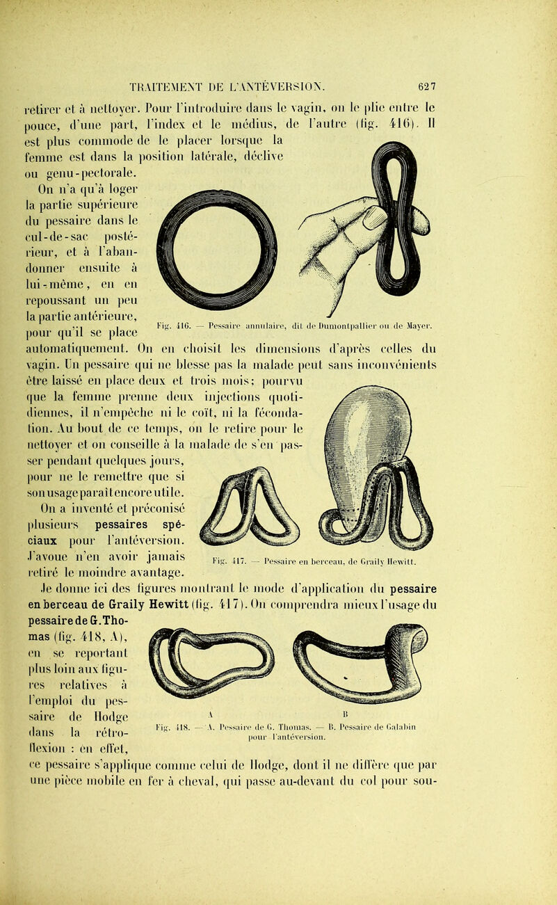 Kiy. il G. — Pessaire annulaire, dit de Dumontpallier ou de Mayer. retirer et à nettoyer. Pour l’introduire dans le vagin, on le plie entre le pouce, d'une part, l’index et le médius, de l’autre (lig. 416). Il est plus commode de le placer lorsque la femme est dans la position latérale, déclive ou genu- pectorale. On n’a qu’à loger la partie supérieure du pessaire dans le cul-de-sac posté- rieur, et à l’aban- donner ensuite à lui -, même, en en repoussant un peu la partie antérieure, pour qu’il se place automatiquement. On en choisit les dimensions d’après celles du vagin. Un pessaire qui ne blesse pas la malade peut sans inconvénients être laissé en place deux et trois mois; pourvu que la femme prenne deux injections quoti- diennes, il n’empêche ni le coït, ni la féconda- tion. Au bout de ce temps, on le retire pour le nettoyer et on conseille à la malade de s’en pas- ser pendant quelques jours, pour ne le remettre que si son usage paraît encore utile. On a inventé et préconisé plusieurs pessaires spé- ciaux pour l’antéversion. J’avoue n’en avoir jamais retiré le moindre avantage. Je donne ici des ligures montrant le mode d’application du pessaire en berceau de Graily Hewitttlig. 417). On comprendra mieux l’usage du pessaire de G.Tho- mas (fig. 418, A), en se reportant plus loin aux ligu- res relatives à l’emploi du pes- saire de Hodge dans la rétro- llexion : en effet, ce pessaire s’applique comme celui de Hodge, dont il ne dilfère que par une pièce mobile en fer à cheval, qui passe au-devant du col pour sou- ut. — Pessaire en berceau, île Graily llewitt. A lt US. - A. Pessaire de G. Thomas. — 1>. Pessaire de Galahin pour l’antéversion.