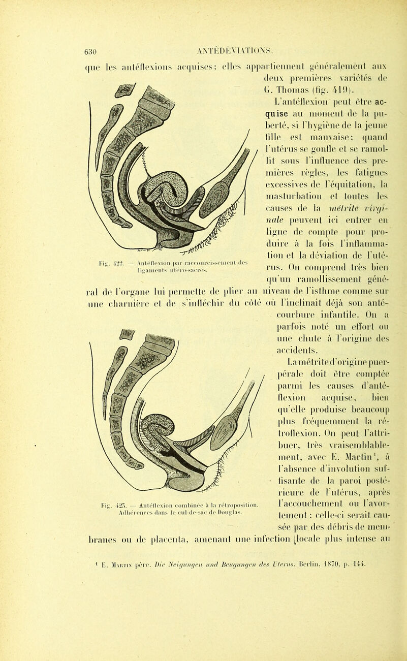 Fig. (22. — Anléfloxion par raccourcissement des 1 igamen ts n tér< >-sa crés. 630 ANTEDI5VIVTIONS. que les anléflexions actpiises; ('Iles appartiennent généralement aux deux premières variétés de (i. Thomas (fig. 41 fl). L’antéflexion peut être ac- quise au moment de la pu- berté, si l’hygiène de la jeune Tille est mauvaise: quand l’utérus se go n lie et se ramol- lit sous l'influence des pre- mières règles, les fatigues excessives de l’équitation, la masturbation et toutes les causes de la mélrite virgi- nale peuvent ici entrer en ligne de compte pour pro- duire à la fois l'inflamma- tion et la déviation de l'uté- rus. On comprend très bien qu’un ramollissement géné- ral de l’organe lui permette de plier au niveau de l’isthme comme sur une charnière ('I de s’infléchir du côté où l’inclinait déjà son anté- courbure infantile. On a parfois noté un effort ou une chute à l’origine des accidents. La mélrite d'origine puer- pérale doit être comptée parmi les causes d’anté- flexion acquise, bien qu'elle produise beaucoup plus fréquemment la ré- troflexion. On peut l'attri- buer, très vraisemblable- ment, avec K. Martin1, à l'absence d’involution suf- fisante de la paroi posté- rieure de l’utérus, après l'accouchement ou l’avor- tement : celle-ci serait cau- sée par des débris de mem- branes ou de placenta, amenant une infection [locale plus intense an Fig. 425. - Antéilcxion combinée a In rétroposilion. Adhérences dans le cul-de-sac. de Douglas. 1 K. Martin père. Die Neigwigeit iinil Bettginir/cn îles Vferus. Berlin. 1870. p. lti.