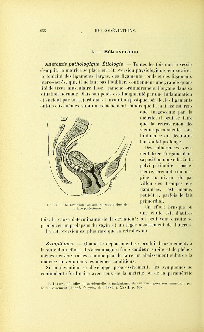 I. — Rétroversion. Anatomie pathologique. Étiologie. 'foules les lois que la vessie s'emplit, la matrice se place en rétroversion physiologique temporaire; la tonicité des ligaments larges, des ligaments ronds et dos ligaments uléro-sacrés, qui, il ne faut pas l’oublier, contiennent une grande quan- tité de tissu musculaire lisse, ramène ordinairement l’organe dans sa situation normale. Mais son poids est-il augmenté par une inflammation et surtout par un retard dans l involution post-puerpérale, les ligaments ont-ils eux-mêmes subi un relâchement, tandis que la matrice est ren- due turgescente par la inédite, il peut se faire «pie la rétroversion de- vienne permanente sous l’influence du décubitus horizontal prolongé. Des adhérences vien- nent fixer l’organe dans sa position nouvelle. Cette pelvi-péritonite posté- rieure, prenant son ori- gine au niveau du pa- villon des trompes en- flammées, est même, peut-être, parfois le fait primordial. Un effort brusque ou une chute est, d’autres fois, la cause déterminante de la déviation1 ; on peut voir ensuite se prononcer un prolapsus du vagin et un léger abaissement de l’utérus. La rétroversion est plus rare que la rélrollexion. Symptômes. — Quand le déplacement se produit brusquement, à la suite d’un elfort, il s’accompagne d’une douleur subite et de phéno- mènes nerveux variés, comme peut le faire un abaissement subit de la matrice survenu dans les mêmes conditions. Si la déviation se développe progressivement, les symptômes se confondent d’ordinaire avec ceux de la inétrile ou de la paramélrite 1 I1. Th i m x. Ilélrollexion accidentelle el instantanée de l’utérus ; guérison immédiate par le redressement Annal. <lr f/yn.. déc. 18X9, t. XXXII, p. 405). Kig. 127. liétroversion avec adhérences étendues de la lace postérieure.