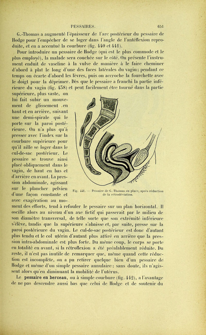 G.-Thomas a augmenté l’épaisseur de l’arc postérieur du pessaire de Hodge pour l’empêcher de se loger dans l'angle de l’antéflexion repro- duite, et en a accentué la courbure (fig. 440 et 441). Pour introduire un pessaire de Hodge (qui est le plus commode et le plus employé), la malade sera couchée sur le côté. On présente l’instru- ment enduit de vaseline à la vulve de manière à le faire cheminer d’abord à plat le long d’une des faces latérales du vagin; pendant ce temps on écarte d’abord les lèvres, puis on accroche la fourchette avec le doigt pour la déprimer. Dès que le pessaire a franchi la partie infé- rieure du vagin (fig. 458) et peut facilement être tourné dans la partie supérieure, plus vaste, on lui fait subir un mouve- ment de glissement .en haut et en arrière, suivant une demi-spirale qui le porte sur la paroi posté- rieure. On n’a plus qu’à presser avec l’index sur la courbure supérieure pour qu’il aille se loger dans le cul-de-sac postérieur. Le pessaire se trouve ainsi placé obliquement dans le vagin, de haut en bas et d’arrière en avant. La pres- sion abdominale, agissant sur le plancher pelvien d’une façon constante et avec exagération au mo- ment des efforts, tend à refouler le pessaire sur un plan horizontal. Il oscille alors au niveau d’un axe fictif qui passerait par le milieu de son diamètre transversal, de telle sorte que son extrémité inférieure s’élève, tandis que la supérieure s’abaisse et, par suite, presse sur la paroi postérieure du vagin. Le cul-de-sac postérieur est donc d’autant plus tendu et le col utérin d’autant plus attiré en arrière que la pres- sion intra-abdominale est plus forte. Du même coup, le corps se porte en totalité en avant, si la rétroflexion a été préalablement réduite. Du reste, il n’est pas inutile de remarquer que, même quand cette réduc- tion est incomplète, on a pu retirer quelque bien d’un pessaire de Hodge et même d’un simple pessaire annulaire; sans doute, ils n’agis- sent alors qu’en diminuant la mobilité de l’utérus. Le pessaire en berceau, ou à simple courbure (fig. 442), a Davantage de ne pas descendre aussi bas que celui de Hodge et de soutenir du