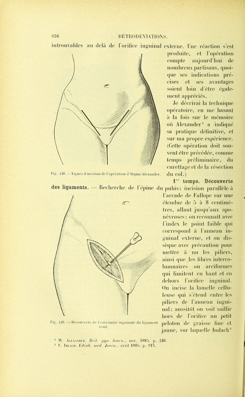 avantages égale- introuvables an delà de l’orifice inguinal externe, l'ne réaction s’est produite, et l’opération compte aujourd’hui de nombreux partisans, quoi- que ses indications pré- cises et ses soient loin d’être ment appréciés. Je décrirai la technique opératoire, en me basant à la fois sur le mémoire où Alexander1 a indiqué sa pratique définitive, et sur ma propre expérience. (Cette opération doit sou- vent être précédée, comme temps préliminaire, du curettage et de la résection Fig. i 18. — Lignes d'incision de l'opération d'Alquié-Alexander. d 11 col. ) 1er temps. Découverte des ligaments. — Recherche de l’épine du pubis; incision parallèle à l’arcade de Fallope sur une étendue de 5 à 8 centimè- tres, allant jusqu’aux apo- névroses: on reconnaît avec l’index le point faible qui correspond à l’anneau in- guinal externe, et on dis- sèque avec précaution pour mettre à nu les piliers, ainsi que les fibres interco- lumnaires ou arciformes qui limitent en haut et en dehors l’orifice inguinal. On incise la lamelle cellu- leuse qui s’étend entre les piliers de l’anneau ingui- nal; aussitôt on voit saillir hors de l’orifice un petit Fig’. 419. — Découverte de l'extrémité inguinale du ligament nglotOIÎ de °TcUSSC (illC Cl rond 1 jaune, sur laquelle Imlacli 1 \Y. Alexander, lirit. gyn. Jour»., nov. 1885, p. 246. - F. Imlacii. Edinb. mcd. Jour»., avril 1885, p. 015.