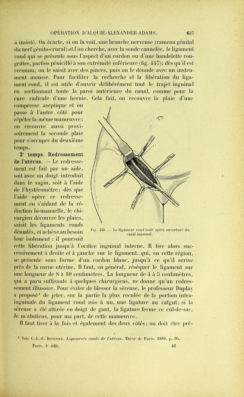 a insisté. On écarte, si on la voit, une branche nerveuse (rameau génital <lu nerf génito-crural) et l’on cherche, avec la sonde cannelée, le ligament rond qui se présente sous l’aspect d’un cordon ou d’une bandelette rou- geâtre, parfois pénicillé à son extrémité inférieure (tîg. 447); dès qu’il est reconnu, on le saisit avec des pinces, puis on le dénude avec un instru- ment mousse. Pour faciliter la recherche et la libération du liga- ment rond, il est utile d’ouvrir délibérément tout le trajet inguinal en sectionnant toute la paroi antérieure du canal, comme pour la cure radicale d’une hernie. Cela fait, on recouvre la plaie d’une corn [tresse asep tique et on passe à l’autre côté pour répéter la môme manœuvre ; on recouvre aussi provi- soirement la seconde plaie pour s’occuper du deuxième temps. 2° temps. Redressement de l’utérus. —- Le redresse- ment est fait par un aide, soit avec un doigt introduit dans le vagin, soit à l’aide de l’hystéromètre ; dès que l’aide opère ce redresse- ment en s’aidant de la ré- duction bi-manuelle, le chi- rurgien découvre les plaies, saisit les ligaments ronds dénudés, et achève au besoin leur isolement : il poursuit cette libération jusqu’à l’orifice inguinal interne. Il lire alors suc- cessivement à droite et à gauche sur le ligament, qui, en cette région, se présente sous forme d’un cordon blanc, jusqu’à ce qu’il arrive [très de la corne utérine. Il faut, en général, réséquer le ligament sur une longueur de 8 à 10 centimètres. La longueur de 4 à 5 centimètres, qui a paru suffisante à quelques chirurgiens, ne donne qu’un redres- sement illusoire. Pour éviter de blesser la séreuse, le professeur Duplav a proposé1 de jeter, sur la partie la plus reculée de la portion intra- inguinale du ligament rond mis à nu, une ligature au catgut; si la séreuse a été attirée en doigt dè gant, la ligature ferme ce cul-de-sac. Je m’abstiens, pour ma part, de cette manœuvre. U faut tirer à la fois et également des deux côtés; on doit être pré- Fig. KO. — Le ligament rond isolé après ouverture du canal inguinal. ‘■Voir C.-L.-E. Beiiunikr. Ligaments rancis de l’utérus. Thèse de Paris, 1886, p. 95. Pozzi. 4e édit. 42