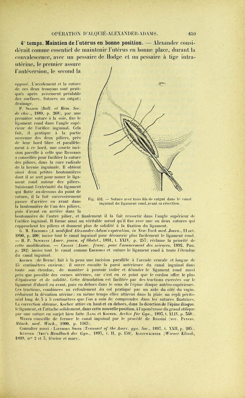 4 temps. Maintien de l’utérus en bonne position. — Alexander consi- dérait comme essentiel de maintenir l’utérus en bonne place, durant la convalescence, avec un pessaire de Ilodge et un pcssaire à tige intra- utérine, le premier assure l’antéversion, le second la opposé. L’accolement cl la suture de ces deux tronçons sont prati- qués après avivement préalable des surfaces. Sutures au catgut; drainage. P. Second [Bull, et Mém. Soc. <lc cliir., 1889, p. 268), par une première suture à la soie, lixe le ligament rond dans l’angle supé- rieur de l’orifice inguinal. Cela fait, il pratique à la partie moyenne des deux piliers, près de leur bord libre et parallèle- ment à ce bord, une courte inci- sion pareille à celle que Reverdix a conseillée pour faciliter la suture des piliers, dans la cure radicale <bi la hernie inguinale. Il obtient ainsi deux petites boutonnières dont il se sert pour nouer le liga- ment rond autour des piliers. Saisissant l’extrémitc du ligament qui Hotte au-dessous du point de suture, il la fait successivement passer d'arrière en avant dans la boutonnière de l’un des piliers, puis d’avant en arrière dans la boutonnière de l’autre pilier, et finalement il la fait ressortir dans l’angle supérieur de l’orifice inguinal. Il forme ainsi un véritable nœud qu’il fixe avec une ou deux sutures qui rapprochent les piliers et donnent plus de solidité à la fixation du ligament. G. M. Edebohls (A modi.fied Alexander-Adam s opération, in New-York med. Journ., Tl ocl. 1890, p. 400) incise tout le canal inguinal pour découvrir plus facilement le ligament rond. — H. P. Newmanx [Amer, journ. of Obstet., 1891, t. XXIV, p. 257) réclame la priorité de cette modification. — Chalot (Assoc. franç. pour l’avancement des sciences, 1892, Pau. p. 282) incise tout le canal comme Edecoiii.s et suture le ligament rond à toute l’étendue du canal inguinal. Rocher (de Berne) fait à la peau une incision parallèle à l’arcade crurale et longue de 15 centimètres environ; il ouvre ensuite la paroi antérieure du canal inguinal dans toute son étendue, de manière à pouvoir isoler et dénuder le ligament rond aussi près que possible des cornes utérines, car c’est en ce point que le cordon offre le plus d’épaisseur et de solidité. Cette dénudation est facilitée par des tractions exercées sur le ligament d’abord en avant, puis en dehors dans le sens de l’épine iliaque antéro-supérieure. Ces tractions, combinées au refoulement du col pratiqué par un aide du côté du vagin, réduisent la déviation utérine; en même temps elles attirent dans la plaie un repli périto- néal long de 5 à 5 centimètres que l’on a soin de comprendre dans les sutures fixatrices. La correction obtenue, Rocher attire en haut et en dehors, dans la direction de l’épine iliaque, le ligament, et l’attache solidement, dans cette nouvelle position, à l’aponévrose du grand oblique par une suture en surjet bien faite (Lang et Rocher. Archiv fur Gyn., 1893, t. XL1V, p. 348). Wertii conseille de fermer le canal inguinal par le procédé de Bassini (vov. Peters, Münch. med. Woch., 1900, p. 1165). Consulter aussi : Lapthorx Smith [Transact of the Amer. gyn. Soc.. 1897, t. XXII, p. 203). Rëstnf.r (Veit’s Handbuch der Gyn., 1897, I. Il, p. 159). Eleixnvachter [Wiener Klinik, 1899, ir1* 2 et 3, février et mars). Fig. 452. — Suture avec trois fds de catgut dans le canal inguinal du ligament rond,avant sa résection.