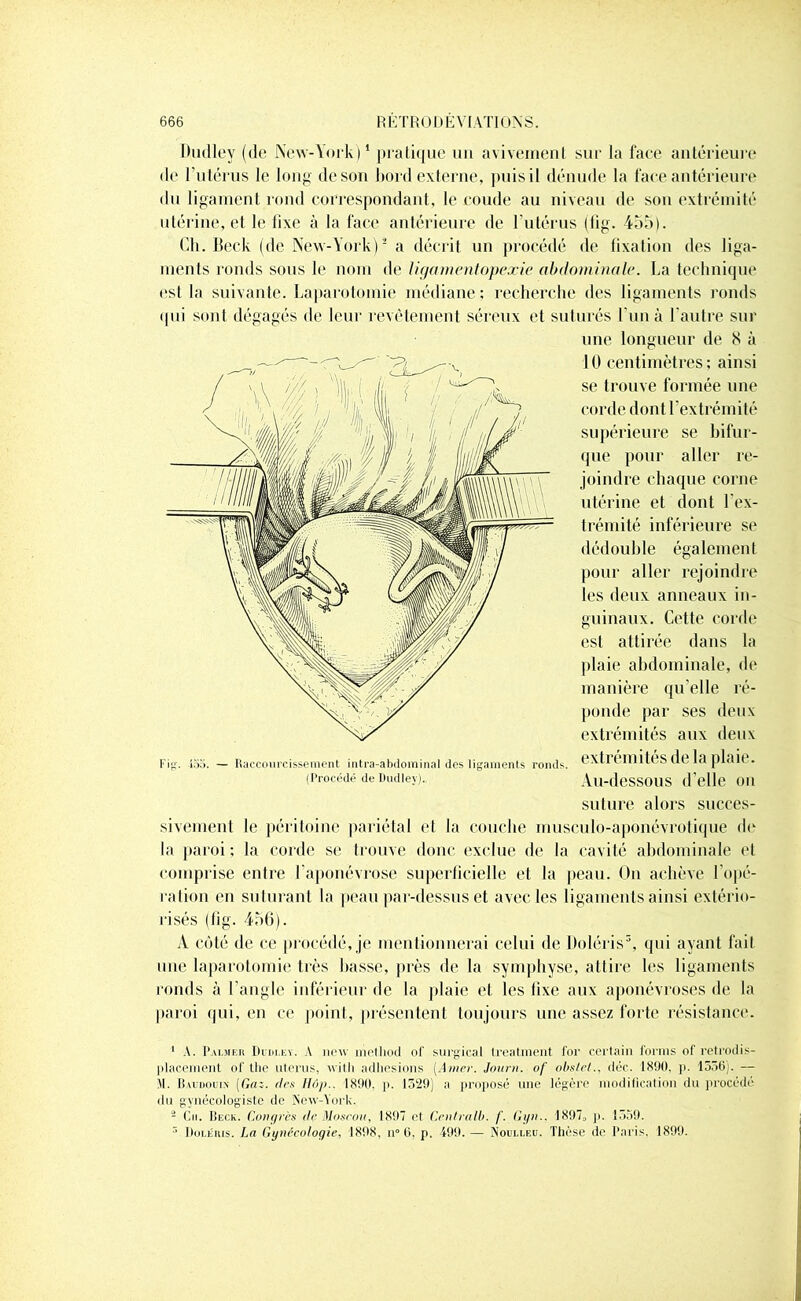 Dudley (de New-York)1 pratique un avivement sur la face antérieure de l'utérus le long de son bord externe, puis il dénude la face antérieure du ligament rond correspondant, le coude au niveau de son extrémité utérine, et le fixe à la face antérieure de l’utérus (fig. 455). Ch. Beck (de New-York)2 a décrit un procédé de fixation des liga- ments ronds sous le nom de ligamentopexie abdominale. La technique est la suivante. Laparotomie médiane; recherche des ligaments ronds qui sont dégagés de leur revêtement séreux et suturés l’un à l’autre sur sivement le péritoine pariétal el la couche musculo-aponêvrotique de la paroi ; la corde se trouve donc exclue de la cavité abdominale et comprise entre l'aponévrose superficielle et la peau. On achève l’opé- ration en suturant la peau par-dessus et avec les ligaments ainsi extério- risés (fig. 456). A côté de ce procédé, je mentionnerai celui de Doléris3, qui ayant fait une laparotomie très basse, près de la symphyse, attire les ligaments ronds à l’angle inférieur de la plaie et les fixe aux aponévroses de la paroi qui, en ce point, présentent toujours une assez forte résistance. 1 A. Palmer Dviu.ey. A new nietliod of surgical Ireatment for certain forms of retrodis- placement of the utérus, with adhesions [Amer. Journ. of obstet., déc. 180(1, p. 1556). — M. Baudouin (Gaz. ries H6p.. 1890, p. 1529) a proposé une légère modification du procédé du gynécologiste de New-York. 2 Cm. Beck. Congrès île Moscou, 1897 et Centralb. (. Gyn.. 1897, p. 1559. 3 Doléris. La Gynécologie, 1898, n° G, p. 499. — Noulleu. Thèse de Paris. 1899. Fig. P». — Raccourcissement intra-abdominal des ligaments rond' (Procédé de Dudley)., une longueur de 8 à 10 centimètres; ainsi se trouve formée une corde dont l’extrémité supérieure se bifur- que pour aller re- joindre chaque corne utérine et dont l’ex- trémité inférieure se dédouble également pour aller rejoindre les deux anneaux in- guinaux. Cette corde est attirée dans la plaie abdominale, de manière qu’elle ré- ponde par ses deux extrémités aux deux extrémités de la plaie. Au-dessous d'elle ou suture alors succès-