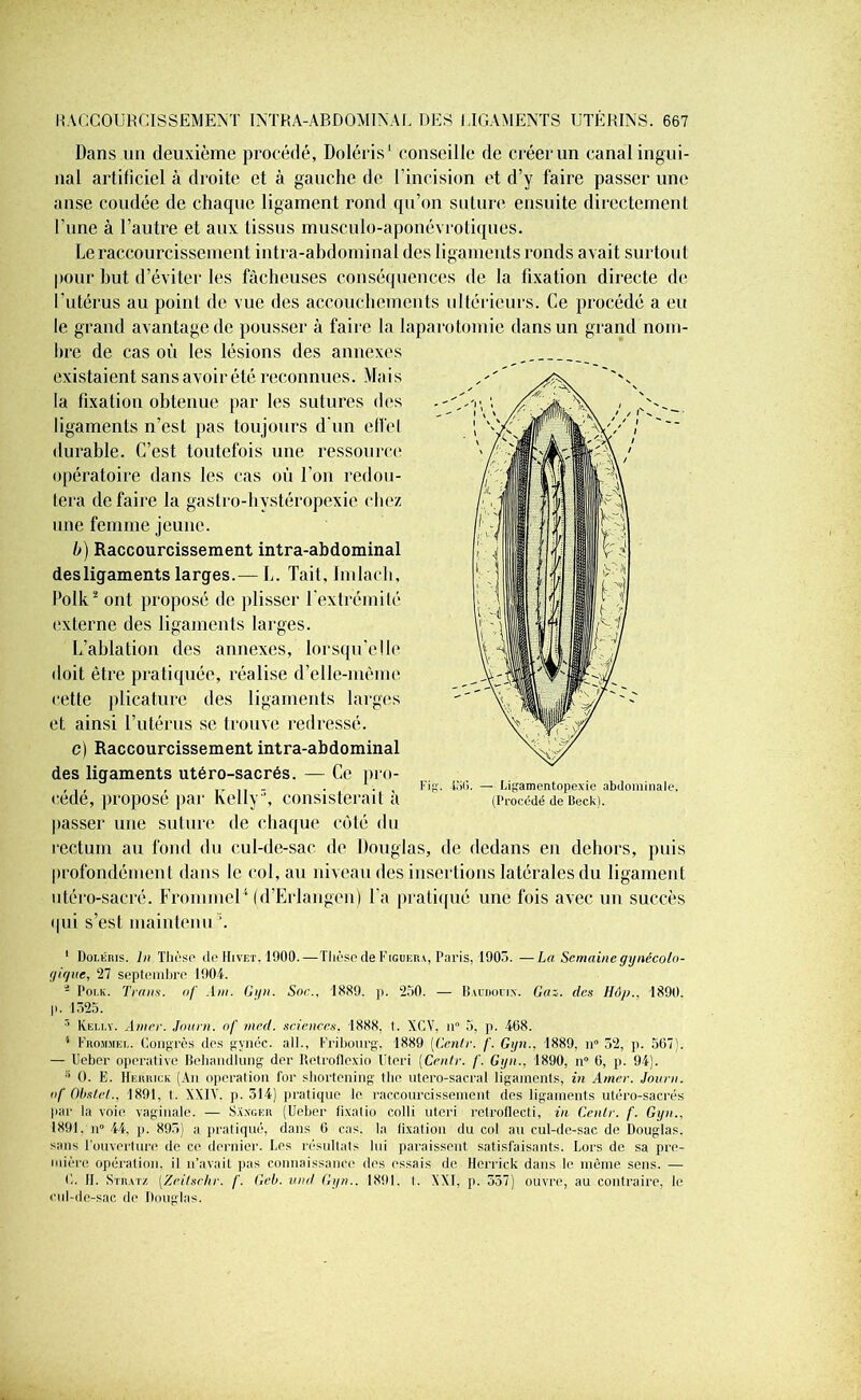 Dans un deuxième procédé, Doléris1 conseille de créer un canal ingui- nal artificiel à droite et à gauche de l’incision et d’y faire passer une anse coudée de chaque ligament rond qu’on suture ensuite directement l’une à l’autre et aux tissus musculo-aponévrotiques. Le raccourcissement intra-abdominal des ligaments ronds avait surtout pour but d’éviter les fâcheuses conséquences de la fixation directe de l’utérus au point de vue des accouchements ultérieurs. Ce procédé a eu le grand avantage de pousser à faire la laparotomie dans un grand nom- bre de cas où les lésions des annexes existaient sans avoir été reconnues. Mais la fixation obtenue par les sutures des ligaments n’est pas toujours d'un elfel durable. C’est toutefois une ressource opératoire dans les cas où l’on redou- tera défaire la gastro-hystéropexie chez une femme jeune. b) Raccourcissement intra-abdominal des ligaments larges.— L. Tait, Imlacli, folk2 ont proposé de plisser l'extrémité externe des ligaments larges. L’ablation des annexes, lorsqu’elle doit être pratiquée, réalise d’elle-même cette plicature des ligaments larges et ainsi l’utérus se trouve redressé. c) Raccourcissement intra-abdominal des ligaments utéro-sacrés. — Ce pro- , , T _ . . Fig-. ioG. — Ligamentopexie abdominale. cede, propose par Kelly, consisterait a (Procédé de Beck). passer une suture de chaque côté du rectum au fond du cul-de-sac de Douglas, de dedans en dehors, puis profondément dans le col, au niveau des insertions latérales du ligament utéro-sacré. Frominel1 (d’Erlangen) Ta pratiqué une fois avec un succès (|ui s’est maintenu ;. 1 Dolkris. In Thèse de Hivet. 1900.—Thèse de Liguera, Paris, 1905. —La Semaine gynécolo- gique, 27 septembre 1904. - Poi.k. Tram, of Am. Gyn. Soc.. 1889. p. 250. — Baudouin. Gai. des Hop., 1890. j). 1525. 5 Kelly. Amer. Journ. of med. sciences. 1888, t. XCV, il” 5, p. 468. 4 Fromjiel. Congrès des gyncc. ail., Fribourg. 1889 (Venir. /'. Gyn., 1889, n° 52, p. 567). — Ueber operative Behandlung der Retroflexio Uteri (Cenlr. /'. Gyn., 1890, n° 6, p. 94). s 0. E. Hekuick (An operation for shortening the utero-sacral ligaments, in Amer. Journ. of Obslel., 1891, t. XXIV. p. 314) pratique le raccourcissement des ligaments utéro-sacrés par la voie vaginale. — Sangkr (Ueber fixatio colli uteri retroflecti, in Cenlr. f. Gyn., 1891, n° 44, ji. 895) a pratiqué, dans 6 cas. la fixation du col au cul-de-sac de Douglas, sans l’ouverture de ce dernier. Les résultats lui paraissent satisfaisants. Lors de sa pre- mière opération, il n’avait pas connaissance des essais de Derrick dans le même sens. — C. IL Stratz [Zeilschr. /'. Geb. und Gyn.. 1891. 1. XXI, p. 337) ouvre, au contraire, le cul-de-sac de Douglas.