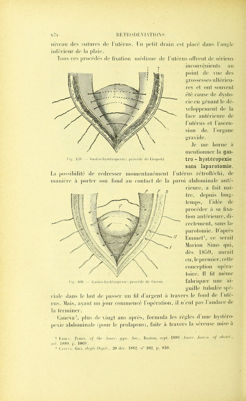 niveau (les salures de l'utérus. 1 n pelit drain esl placé dans l'angle inférieur de la plaie. Tous ces procédés de fixation médiane de l'utérus offrent de sérieux inconvénients au point de vue des grossesses ultérieu- res et onl souvent été cause de dysto- cie en gênant le dé- veloppement de la face antérieure de l'utérus et l’ascen- sion de l'organe gravide. Je me borne à mentionner la gas- Fi. 159. — Gaslro-liysléiojiexie; procédé deL'eopold. tFO - hyStéropexie sans laparotomie. La possibilité de redresser momentanément 1 utérus rétrotléclii. de manière à porter son fond au contact de la paroi abdominale anté- rieure, a fait naî- tre, depuis long- temps, l’idée de procéder à sa lixa- lion antérieure, di- rectement, sans la- parotomie. I> après Emmet1, ce serait Marion Siins qui, dès l(Sà!l, aurait eu, le premier, celle conception opéra- toire. 11 lit même I 460. — (laslrn-liysléropexie ; procédé de Czerny. fabriquer une ai- guille tubulée spé- ciale dans le but de passer un til d argent à travers le fond de I uté- rus. Mais, avant un jour commencé I opération, il n eut pas I audace de la terminer. Caueva*, plus de vingt ans après, formula les règles d une hystéro- pexie abdominale (pour le prolapsus), faite à travers la séreuse mise a 1 Kmmkt. Traits, of tiw Amer. gy». Soc.. Boston, sept. 1889 .4mer. Jour», of obslel.. ncl. 1889, p. 11109 . 5 Caxkvv. Gai. tlrgli. Ûspit., 20 déc. 1882. n° 102, p. 810.