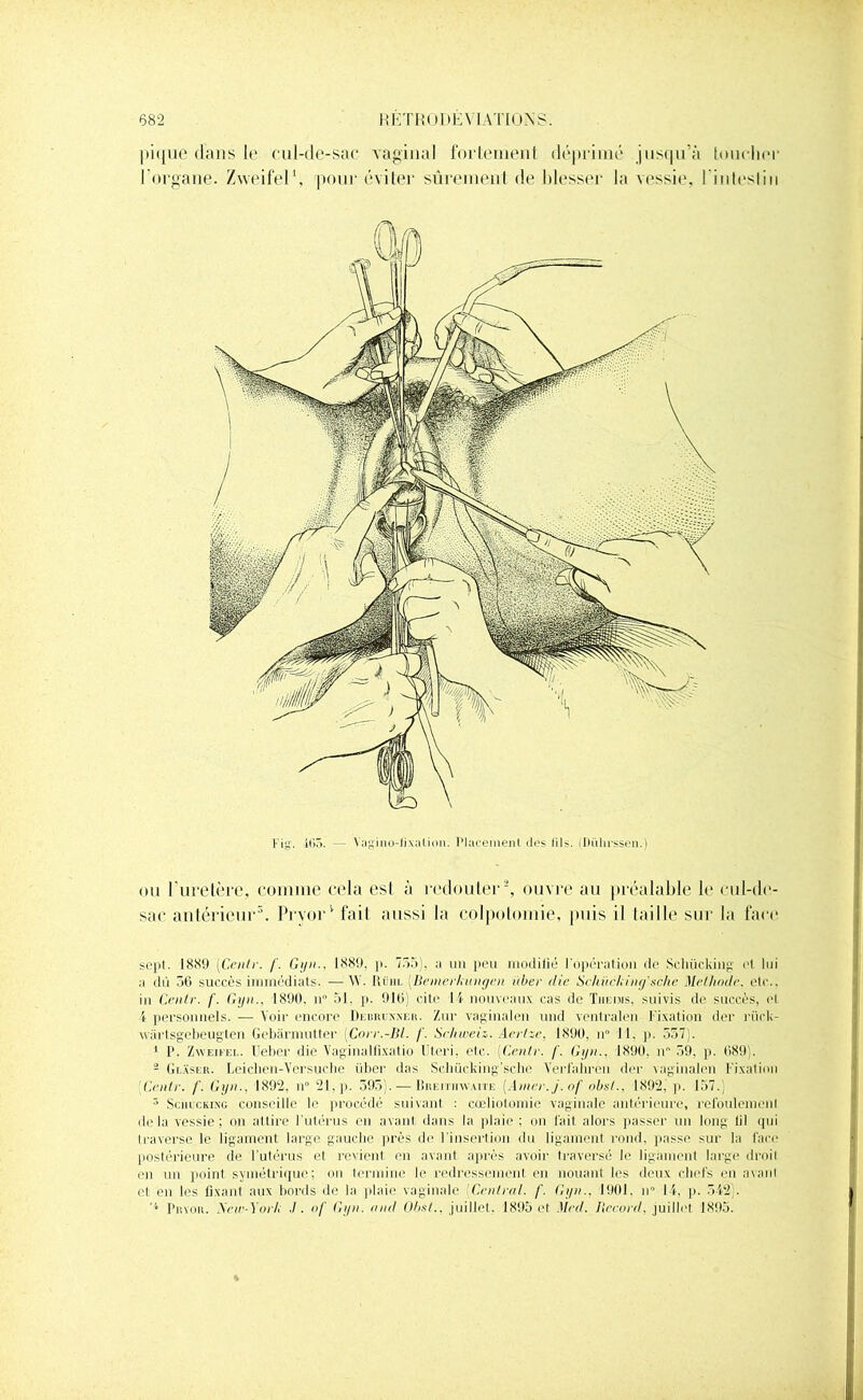 pique dans le cul-de-sac vaginal fortement déprimé jusqu’à loucher l’organe. Zweifel1, pour éviter sûrement de blesser la vessie, l’inleslin Fig. 465. — Yagino-fïxalion. PJaceinenl des iils. (Dührssen.) ou l'uretère, comme cela est à redouter2, ouvre au préalable le cul-de- sac antérieur3. Prvor’fait aussi la colpotomie, puis il taille sur la face sepl. 1889 [Centv. f. Gyn., 1889, p. 755), ;i un peu inodilié l'ûpéi’ation de Schücking et lui ;i dû 56 succès immédiats. —V . Item [Bemevknngen ùber die Schïicki'ng'sche Méthode. etc., in Centv. /'. Gyn., 1890, n° 51, ]). 916) cite 14 nouveaux cas de Tiieims, suivis de succès, e( 4 personnels. — Voir encore Dkuiuxner. Zur vaginalen und ventralen Fixation der riick- wiirtsgebeugten Gebârmutter Cow.-BI. /'. Schweiz. Acvlze, 1890, n° 11. p. 557). 1 P. Zweifel. Ueber die Vaginalfixatio Uteri. etc. [Centv. /'. Gyn., 1890, n 59. p. 689). 2 Glaser. Leichen-Versuche iiber dus Schücking’sche Yerfaliren der vaginalen Fixation Centv. /'. Gyn.. 1892, n° 21, p. 595). — Bueithwaite [Amev.j.of obsl., 1892) p. 157.) 3 Sciiicking conseille le procédé suivant : cœliotomie vaginale antérieure, refoulement de la vessie; on attire l’utérus en avant dans la plaie; on lait alors passer un long lit qui traverse le ligament large gauche près de l’insertion du ligament rond, passe sur la face postérieure de l’utérus et revient en avant après avoir traversé le ligament large droit en un point symétrique; on termine le redressement en nouant les deux chefs en avant cl en les fixant aux bords de la plaie vaginale Cent val. f. Gyn., 1901. n° IV p. 542 . Pbvor. Xeir-Yovli I ■ of Gyn. and Obst., juillet, 1895 et Med. lîecovd, juillet 1895.
