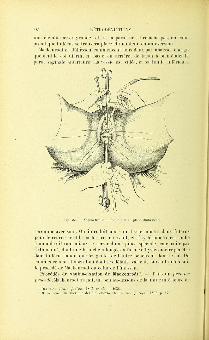 une étendue assez grande, et, si la paroi ne se relâche pas, on com- prend que l’utérus se trouvera placé et maintenu en antéversion. Mackenrodt et Dührssen commencent tous deux par abaisser énergi- quement le col utérin, en bas et en arrière, de façon à bien étaler la paroi vaginale antérieure. La vessie est vidée, et sa limite inférieure Fig. -MU. — Vaginofixation. Les fils sont en place. (Dührssen.) reconnue avec soin. On introduit alors un hystéromètre dans l'utérus pour le redresser et le porter très en avant, et l’hystéromètre est confié à un aide; il vaut mieux se servir d'une pince spéciale, construite par Ortlnnann1, dont une branche allongée en formé d’hystéromètre pénètre dans l'utérus tandis que les griffes de l’autre pénètrent dans le col. On commence alors l’opération dont les détails varient, suivant qu'on suit le procédé de .Mackenrodt ou celui de Dührssen. Procédés de vagino-fixation de Mackenrodt4. — Dans un premier procédé, Mackenrodt traçait, un peu au-dessous de la limite inférieure de 1 Okthmaxx. Centr. f. Gyn.. 1893. n° 45. p. 1038. 2 Mackiîxrodt. Die Thérapie der llctroflcxio Uteri [Centr. f. Gyn., 1892. p. 479).