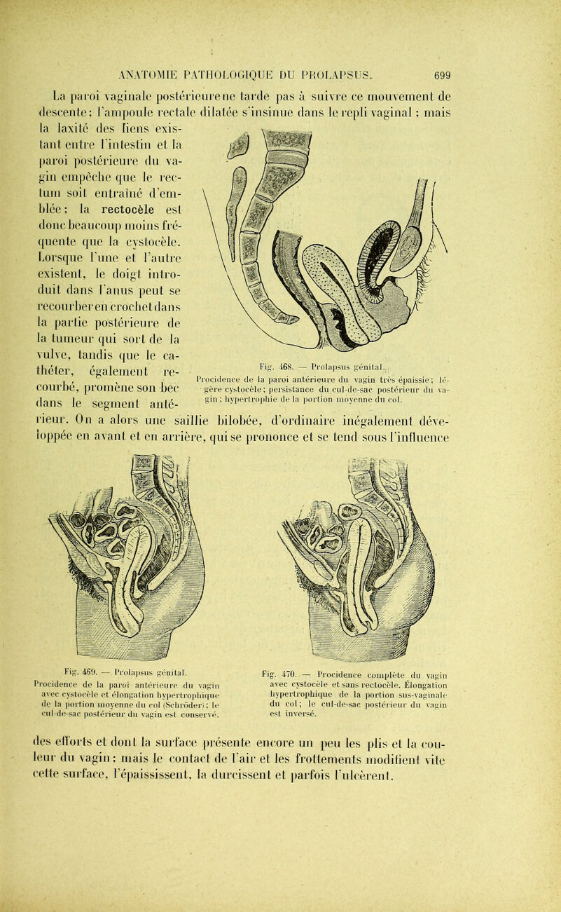 La paroi vaginale postérieure ne tarde pas à suivre ce mouvement de descente; l'ampoule rectale dilatée s’insinue dans le repli vaginal ; mais la laxité des liens exis- tant entre 1 intestin et la paroi postérieure du va- gin empêche que le rec- tum soil entraîné d’em- blée ; la rectocèle est donc beaucoup moins fré- quente que la cvstocèle. Lorsque l’une et l’autre existent, le doigt intro- duit dans l'anus peut se recourberen crochet dans la partie postérieure de la tumeur qui sort de la vulve, tandis que le ca- théter, également re- courbé, promène son bec Procidence de la paroi antérieure du vagin très épaissie : lé- gère cvstocèle; persistance du cul-de-sac postérieur du va- gin: hypertrophie delà portion moyenne du col. dans le segment anté- rieur. On a alors une saillie bilobée, d’ordinaire inégalement déve- loppée en avant et en arrière, qui se prononce et se tend sous l’influence Fig. 46tl. — Prolapsus génital. Procidence de la paroi antérieure du vagin avec cystocèle et élongation hypertrophique de la portion moyenne du col (Schrôderl; le cul-de-sac postérieur du vagin est conservé. hypertrophique de la portion sus-vaginale du col ; le cul-de-sac postérieur du vagin est inversé. des efforts et dont la surface présente encore un peu les plis et la cou- leur du vagin; mais le contact de l’air et les frottements modifient vite cette surface, l’épaississent, la durcissent et parfois l’ulcèrent.