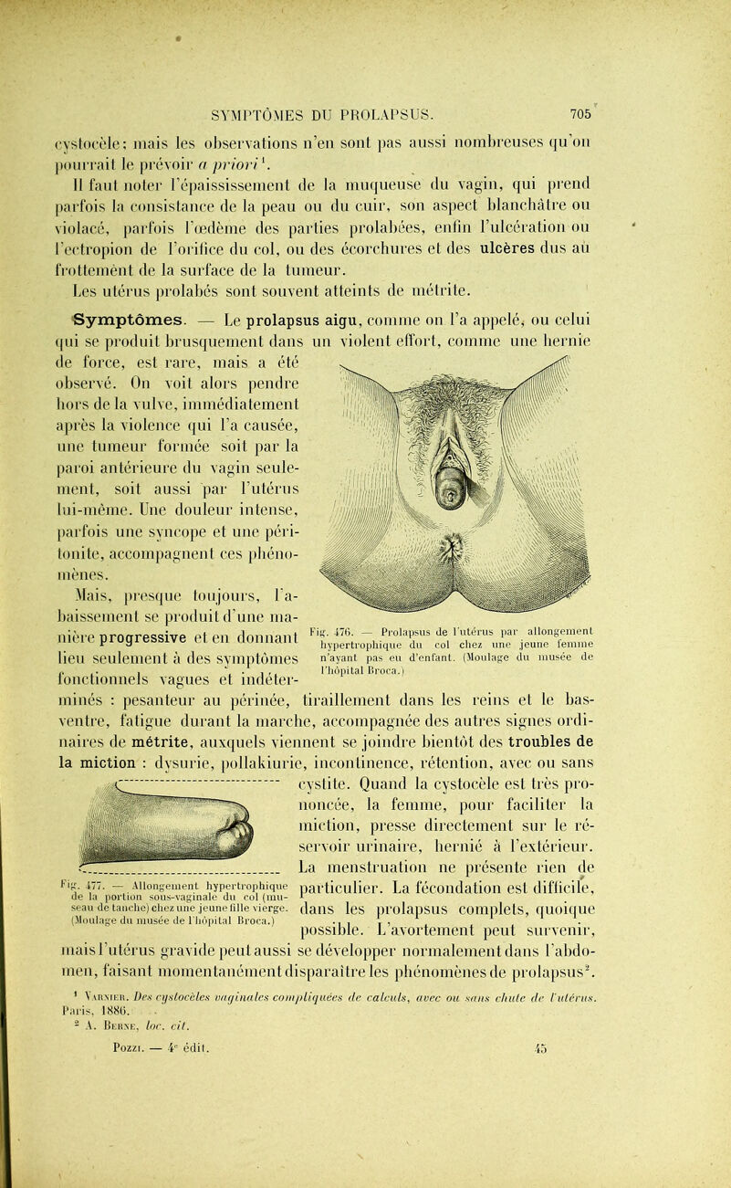eystocèle; niais les observations n’en sont pas aussi nombreuses qu’on pourrait le prévoir a priori1. 11 faut noter l’épaississement de la muqueuse du vagin, qui prend parfois la consistance de la peau ou du cuir, son aspect blanchâtre ou violacé, parfois l’œdème des parties prolabées, enfin l’ulcération ou l’eetropion de l’orifice du col, ou des écorchures et des ulcères dus au frottemènt de la surface de la tumeur. Les utérus prolabés sont souvent atteints de métrite. Symptômes. — Le prolapsus aigu, comme on l’a appelé, ou celui qui se produit brusquement dans un violent effort, comme une hernie de force, est rare, mais a été observé. On voit alors pendre hors de la vulve, immédiatement après la violence qui l’a causée, une tumeur formée soit par la paroi antérieure du vagin seule- ment, soit aussi par l’utérus lui-même. Une douleur intense, parfois une syncope et une péri- tonite, accompagnent ces phéno- mènes. Mais, presque toujours, ra- baissement se produit d’une ma- nière progressive et en donnant lieu seulement à des symptômes fonctionnels vagues et indéter- minés : pesanteur au périnée, tiraillement dans les reins et le bas- ventre, fatigue durant la marche, accompagnée des autres signes ordi- naires de métrite, auxquels viennent se joindre bientôt des troubles de la miction : dvsurie, pollakiurie, incontinence, rétention, avec ou sans cystite. Quand la eystocèle est très pro- noncée, la femme, pour faciliter la miction, presse directement sur le ré- servoir urinaire, hernié à l’extérieur. La menstruation ne présente lien de particulier. La fécondation est difficile, dans les prolapsus complets, quoique possible. L’avortement peut survenir, mais l’utérus gravide peut aussi se développer normalement dans l’abdo- men, faisant momentanément disparaître les phénomènes de prolapsus2. Fis;. -176. — Prolapsus de l’utérus par allongement hypertrophique du col chez une jeune femme n’ayant pas eu d’enfant. (Moulage du musée de l’hôpital Broca.) Fig. -177. — Allongement hypertrophique de la portion sous-vaginale du col (mu- seau de tanche) chez une jeune fille vierge. (Moulage du musée de l’hôpital Broea.) 1 Varmer. Des cystocèles vaginales compliquées tle calculs, avec ou sans cluile de l'utérus. Paris, 1886. 2 A. Berne, loe. cil. 45 Pozzi. — 4 édil.