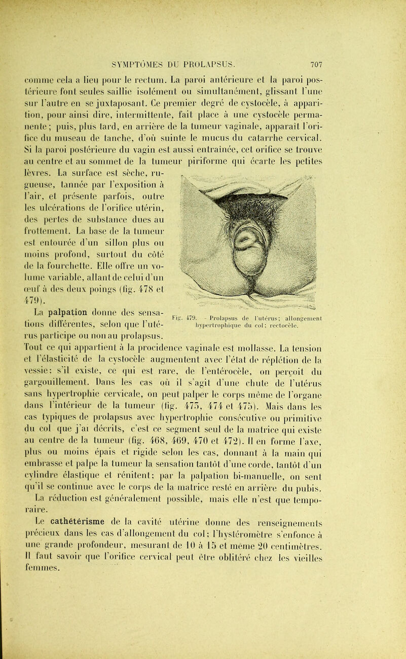 comme cela a lieu pour le rectum. La paroi antérieure et la paroi pos- térieure font seules saillie isolément ou simultanément, glissant l'une sur l’autre en se juxtaposant. Ce premier degré de cystocèle, à appari- tion, pour ainsi dire, intermittente, fait place à une cystocèle perma- nente; puis, plus tard, en arrière de la tumeur vaginale, apparaît l’ori- fice du museau de tanche, d’où suinte le mucus du catarrhe cervical. Si la paroi postérieure du vagin est aussi entraînée, cet orifice se trouve au centre et au sommet de la tumeur piriforme qui écarte les petites lèvres. La surface est sèche, ru- gueuse, tannée par l’exposition à l’air, et présente parfois, outre les ulcérations de l’orifice utérin, des pertes de substance dues au frottement. La hase de la tumeur est entourée d’un sillon plus ou moins profond, surtout du côté de la fourchette. Elle offre un vo- lume variable, allant de celui d’un œuf à des deux poings (tig. 478 et 479). La palpation donne des sensa- r Hg. 479. - Prolapsus de l’utérus; allongement fions dlltérentes, selon que 1 ute- hypertrophique du col; rectocèle. rus participe ou non au prolapsus. Tout ce qui appartient à la procidence vaginale est mollasse. La tension et l’élasticité de la cystocèle augmentent avec l’état de réplétion de la vessie: s’il existe, ce qui est rare, de l’entérocèle, on perçoit du gargouillement. Dans les cas où il s’agit d’une chute de l’utérus sans hypertrophie cervicale, on peut palper le corps même de l’organe dans l’intérieur de la tumeur (tig. 473, 474 et 475). Mais dans les cas typiques de prolapsus avec hypertrophie consécutive ou primitive du col que j’ai décrits, c’est ce segment seul de la matrice qui existe au centre de la tumeur (fig. 468, 469, 470 et 472). Il en forme l’axe, plus ou moins épais et rigide selon les cas, donnant à la main qui embrasse et palpe la tumeur la sensation tantôt d’une corde, tantôt d’un cylindre élastique et rénitent; par la palpation bi-manuelle, on sent qu il se continue avec le corps de la matrice resté en arrière du pubis. La réduction est généralement possible, mais elle n’est que tempo- raire. Le cathétérisme de la cavité utérine donne des renseignements précieux dans les cas d’allongement du col: l’hystéromètre s’enfonce à une grande profondeur, mesurant de 10 à 15 et même 20 centimètres. Il faut savoir que l’orifice cervical peut être oblitéré chez les vieilles femmes.
