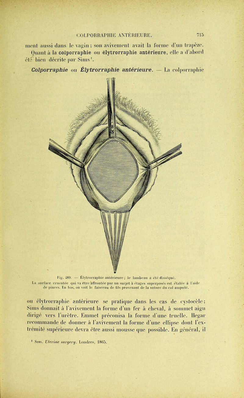 ment aussi dans le vagin; son avivement avait la forme dlun trapèze. Quant à la cotporraphie ou élytrorraphie antérieure, elle a d’abord été bien décrite par Sims Colporraphie ou Élytrorraphie antérieure. — La colporraphie Fig. f89. — Élytrorraphie antérieure ; le lambeau a été disséqué. La surface cruentée qui va être affrontée par un surjet à étages superposés est étalée à l'aide de pinces. En bas, on voit le faisceau de fils provenant de la suture du col amputé. ou élytrorraphie antérieure se pratique dans les cas de cystocèle ; Sims donnait à l’avivement la forme d’un fer à cheval, à sommet aigu dirigé vers l’urètre. Emmet préconisa la forme d'une truelle. Hegar recommande de donner à l’avivement la forme d’une ellipse dont l’ex- trémité supérieure devra être aussi mousse que possible. En général, il 1 Sims. Lierine surgery. Londres, 1805.