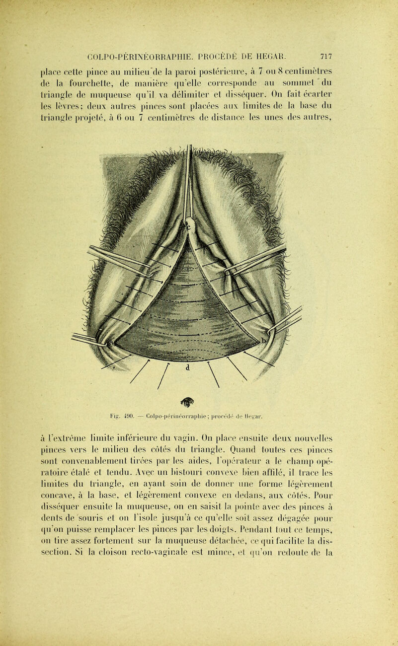 place cette pince au milieu de la paroi postérieure, à 7 ou 8 centimètres de la fourchette, de manière qu’elle corresponde au sommet du triangle de muqueuse qu’il va délimiter et disséquer. On fait écarter les lèvres; deux autres pinces sont placées aux limites de la base du triangle projeté, à fi ou 7 centimètres de distance les unes des autres, Fig. ilJ0. — Cdipo-périnéorrapliie; procétlô de llegar. à l’extrême limite inférieure du vagin. On place ensuite deux nouvelles pinces vers le milieu des côtés du triangle. Quand toutes ces pinces sont convenablement tirées par les aides, l'opérateur a le champ opé- ratoire étalé et tendu. Avec un bistouri convexe bien affilé, il Irace les limites du triangle, en ayant soin de donner une forme légèrement concave, à la base, et légèrement convexe en dedans, aux côtés. Pour disséquer ensuite la muqueuse, on en saisit la pointe avec des pinces à dents de souris et on l'isole jusqu’à ce qu’elle soit assez dégagée pour qu’on puisse remplacer les pinces par les doigts. Pendant tout ce temps, on tire assez fortement sur la muqueuse détachée, ce qui facilite la dis- section. Si la cloison recto-vaginale est mince, et qu’on redoute de la