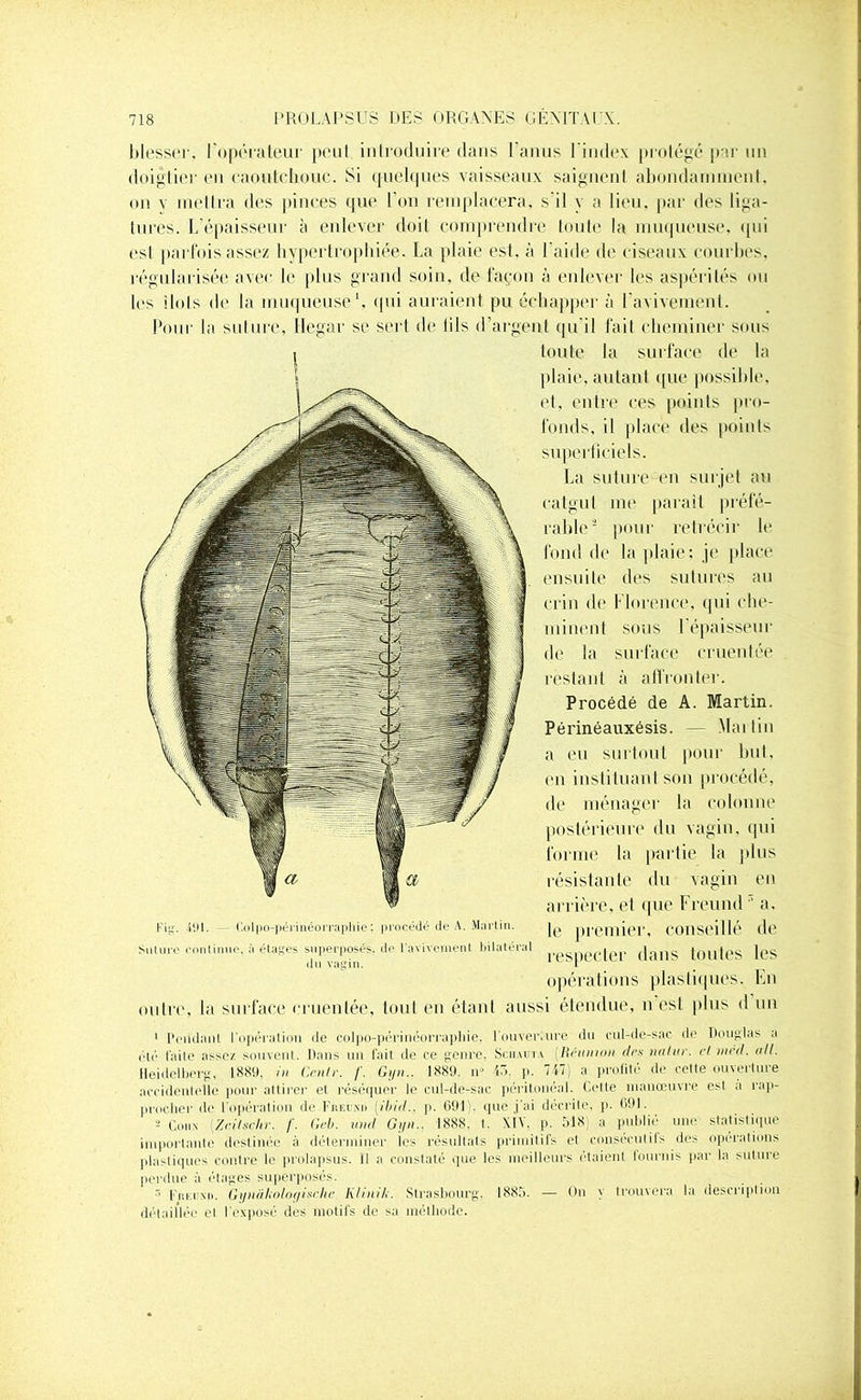 blesser, l'opérateur peut introduire dans l'anus l'index protégé par un doigtier eu caoutchouc. Si quelques vaisseaux saignent abondamment, on v mettra des pinces que l’on remplacera, s'il y a lieu, par des liga- tures. L’épaisseur à enlever doit comprendre toute la muqueuse, qui est parfois assez hypertrophiée. La plaie est. à Laide de ciseaux courbes, régularisée avec le plus grand soin, de façon à enlever les aspérités ou les îlots de la muqueuse1, qui auraient pu échapper à l’avivement. Pour la suture, Hegar se sert «h* lils d’argent qu’il fait cheminer sous toute la surface de la plaie, autant que possible, et, entre ces points pro- fonds, il place des points superficiels. La suture en surjet au catgut me paraît préfé- rable2 pour rétrécir le fond de la plaid? je place ensuite des sutures au crin de Florence, qui che- minent sous 1 épaisseur de la surface cruentée restant à alfronler. Procédé de A. Martin. Périnéauxésis. — Martin a eu surtout pour but, en instituant son procédé, de ménager la colonne postérieure du vagin, qui forme la partie la plus résistante du vagin en arrière, et que Freund  a, le premier, conseillé de respecter dans toutes les opérations plastiques. En outre, la surface cruentée, tout en étant aussi étendue, n est plus d un 1 Pendant l’opéraMpn de coipo-périnéorraphie, l’ouveriure du cul-de-sac de Douglas a clé faite assez souvent. Dans un fait de ce genre. Sciiauta [Réunion dm nalur. cl méd. ait. Heidelberg, 1889. in Ccnlr. /'. Gijn.. 1889. n“ 45. p. 747) a profité de cette ouverture accidentelle pour attirer et réséquer le cul-de-sac péritonéal. Cette manœuvre est a rap- procher de l'opération de I’iikimi (ibid., p. 691 que j'ai décrite, p. 691. 2 Coti.N (Zritsckr. f. Geb. und Gyn.. 1888, I. XIV. p. 518; a publié une statistique importante destinée à déterminer les résultats primitifs et consécutifs des opérations plastiques contre le prolapsus. Il a constaté que les meilleurs étaient fournis par la suture perdue à étages superposés.  f'iiia mi. Gynâliologische K/inili. Strasbourg. 188.i. — On y trouvera la description détaillée et l'exposé des motifs de sa méthode. Kig. 491. Colpo-périnéorrapliie; procédé de A. Martin. Suture continue, à étages superposés, de l’avivement bilatéral du vagin.
